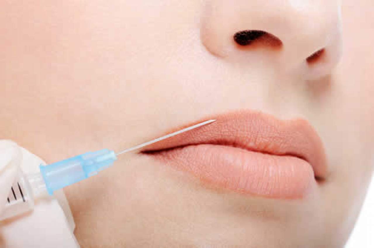 Aumento de labios sin cirugía en Lalín