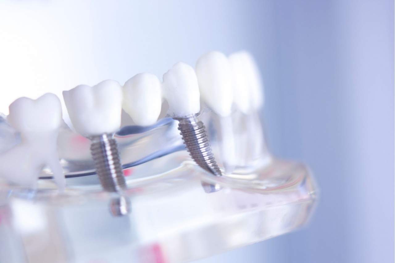 Implante dental Sevilla en la Clínica Dental Helident