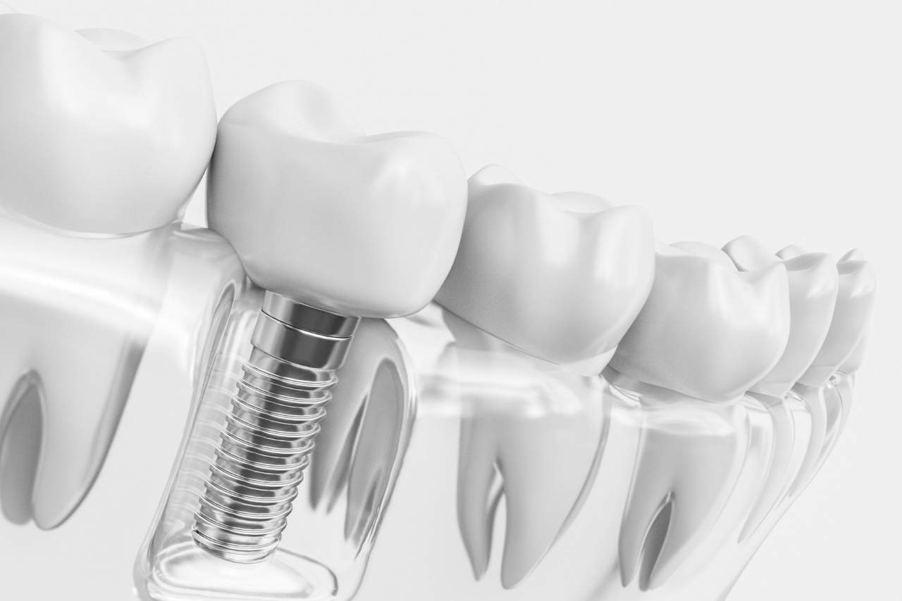 Clínica Helident: Implante dental profesional en Sevilla