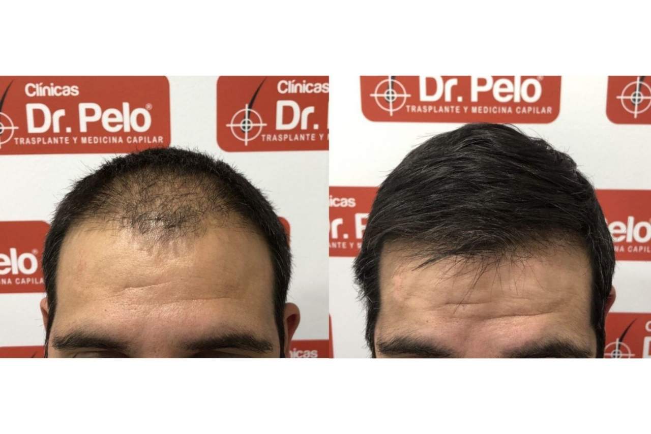 Señales de alopecia por el Dr. Pelo