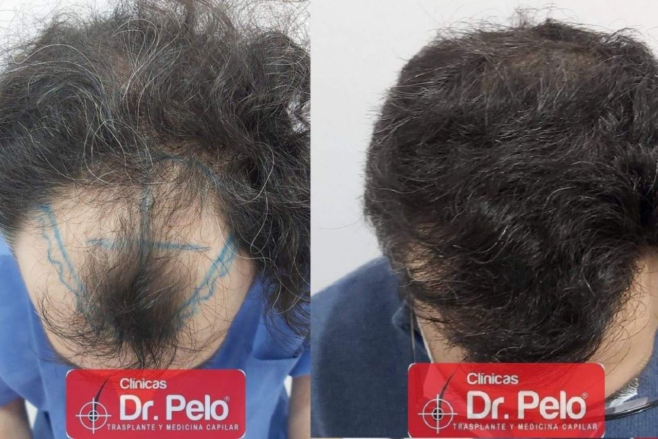 La Clínica Dr. Pelo y su injerto capilar en Sevilla