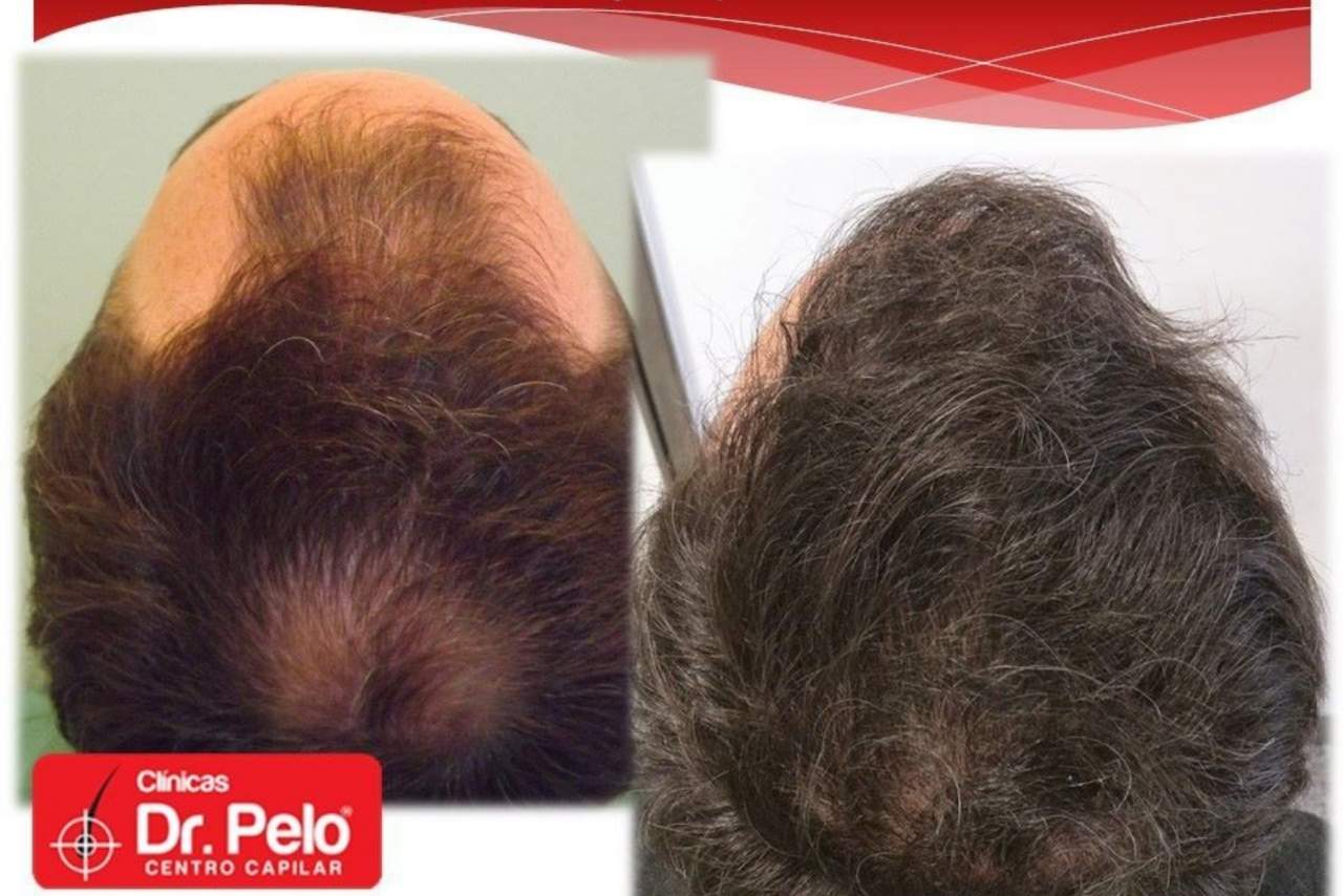 Dr. Pelo: ¿El trasplante capilar es la nueva tendencia en medicina estética?