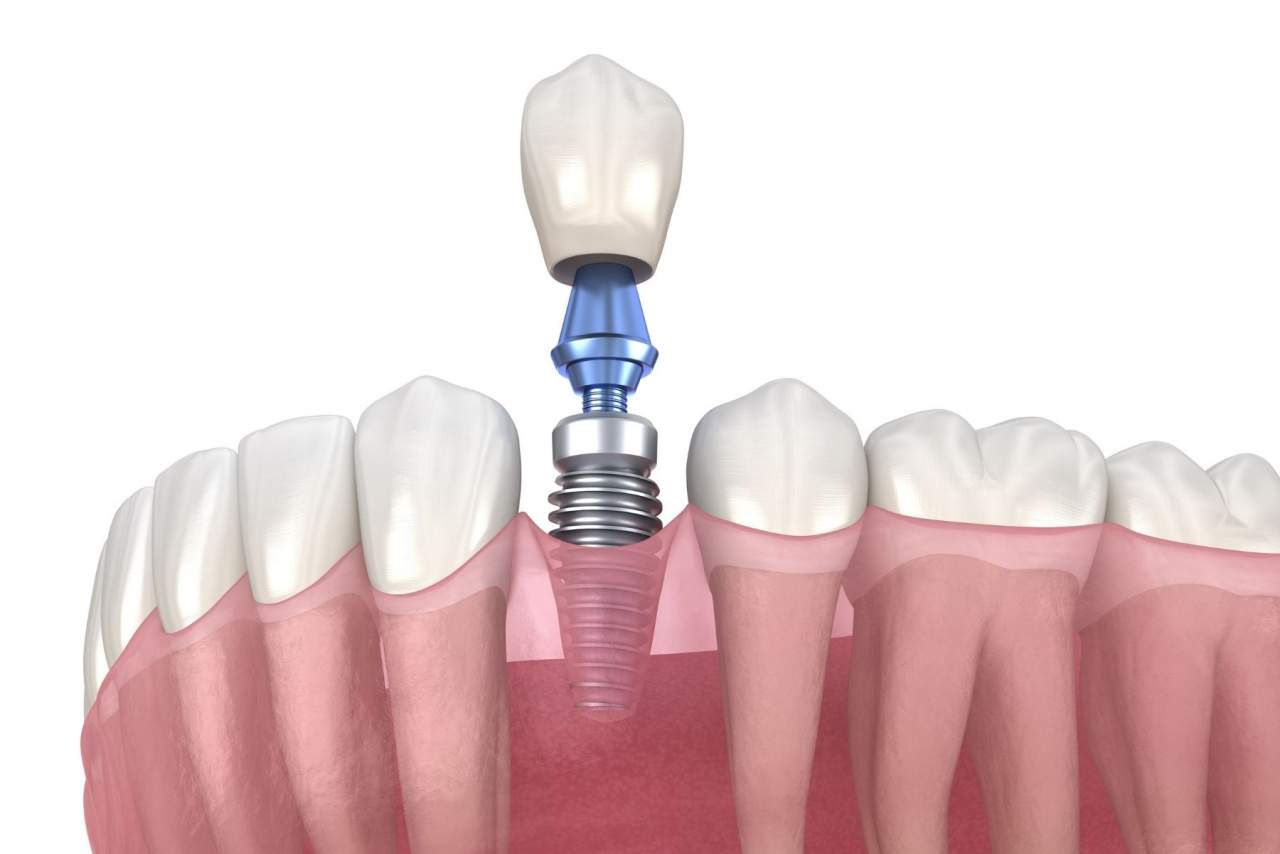 Helident Training Center: ¿Los implantes duran para siempre?¿Qué cuidados necesitan? Por Helident Training Center