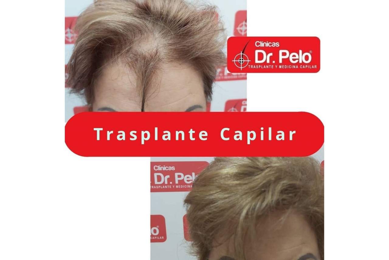 Comentarios sobre el injerto capilar de las Clínicas Dr. Pelo en Sevilla