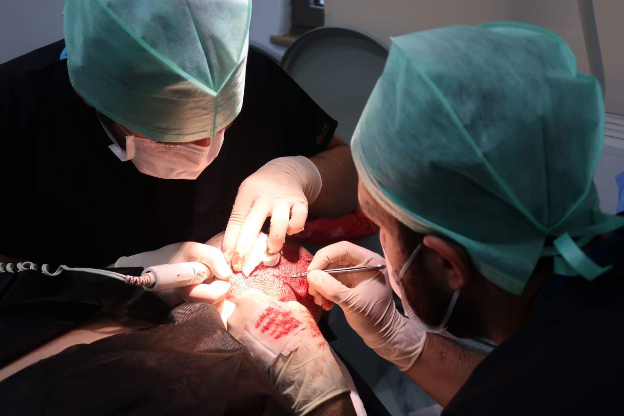 Método DHI por Dr. Bern Barbehito: un 42% de hombres en España son calvos, pero se puede retrasar ese efecto