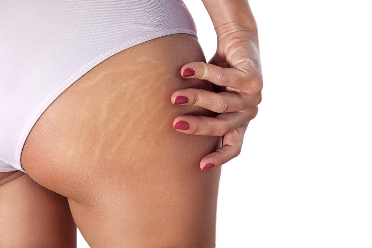 Clínica Estética Alicante: ¿Cómo quitar las estrías?