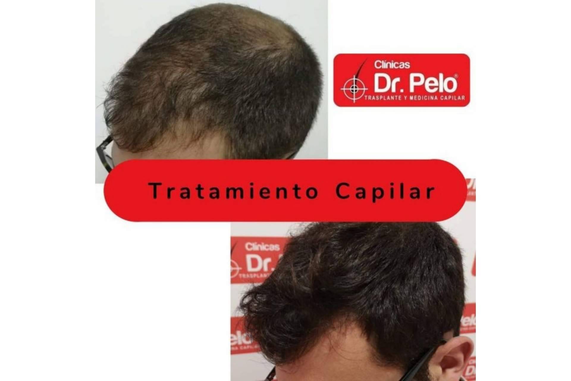 Un tratamiento como el injerto capilar en Sevilla gana popularidad gracias a las Clínicas Dr. Pelo