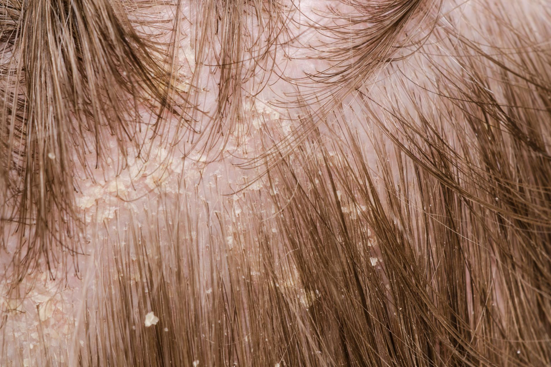 Costras en el cuero cabelludo, el tratamiento creado por el Laboratorio Géomer Pure Nature