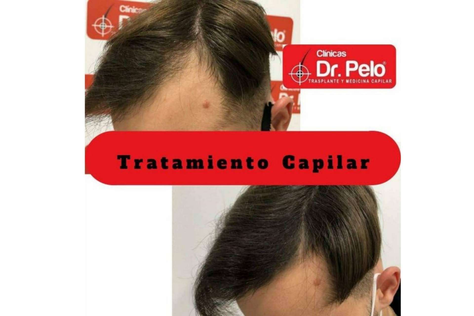 Clínica Dr. Pelo: mejores resultados de trasplante capilar en España