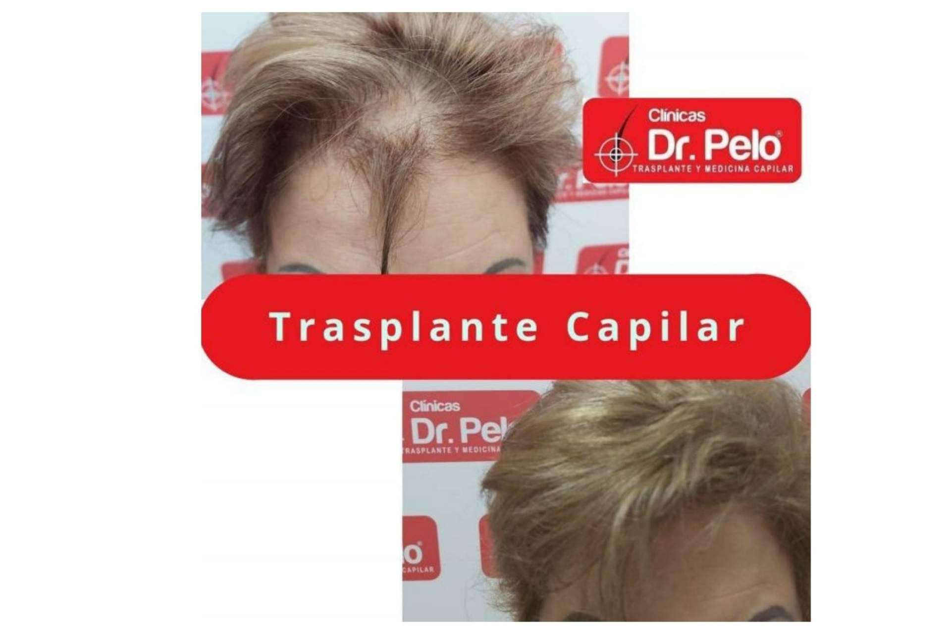 Clínica Dr.Pelo: ¿Cuál es la mejor clínica de injerto capilar en Sevilla?