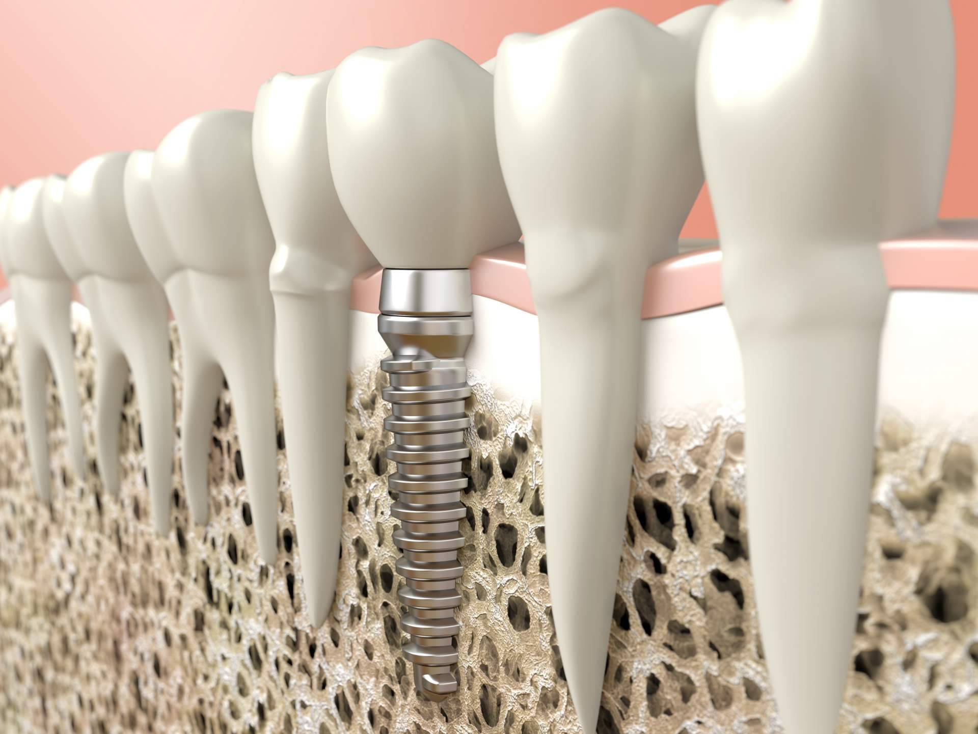 Clínica Dental Heins cuenta con un equipo altamente cualificado para realizar tratamientos de implantes dentales y ortodoncia invisible
