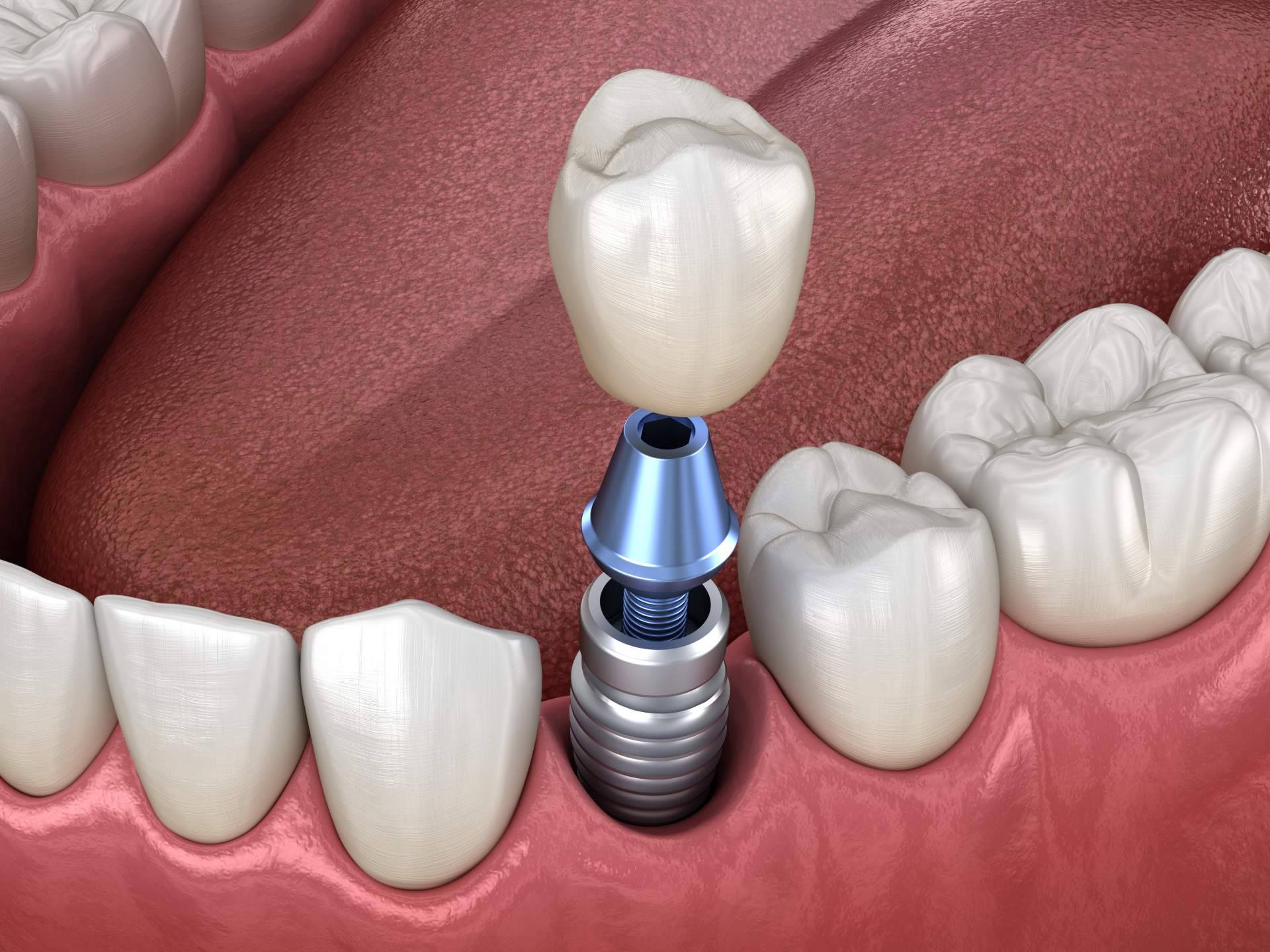 La Clínica dental especializada Artydents en Madrid ofrece tener los dientes fijos en un día