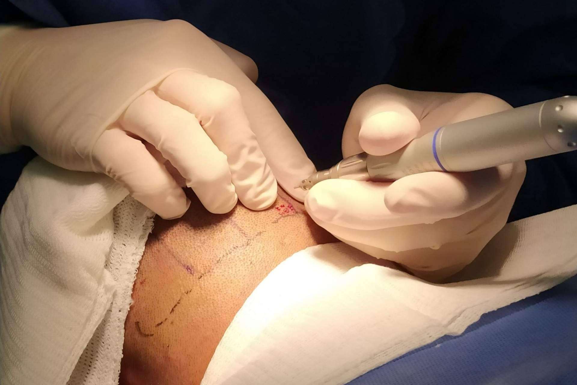 La técnica del microinjerto capilar realizada por Clínica Tarrazo, la clínica estética de Alcobendas