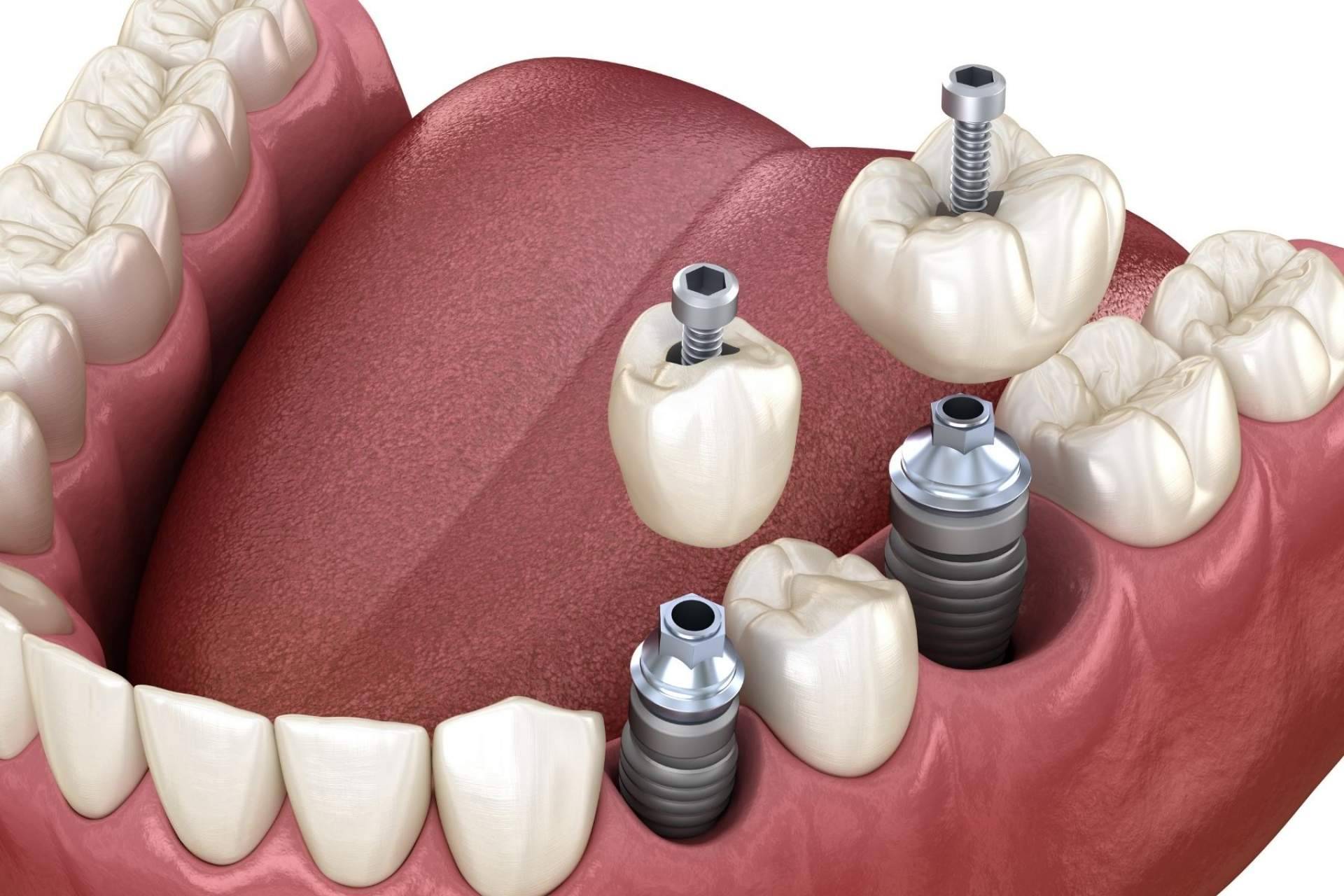 Implant Clinics: los implantes de carga inmediata