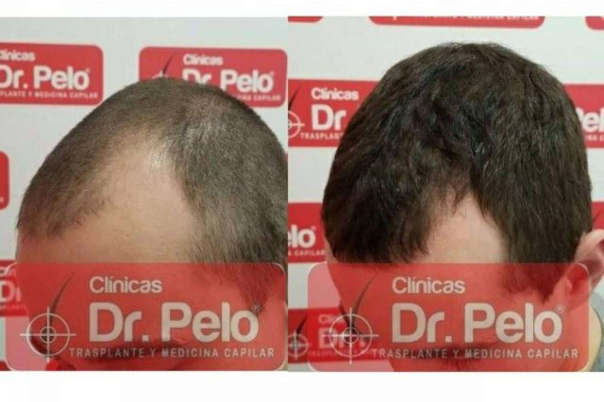 Resultados visibles con el láser capilar LedHair: Dr. Pelo