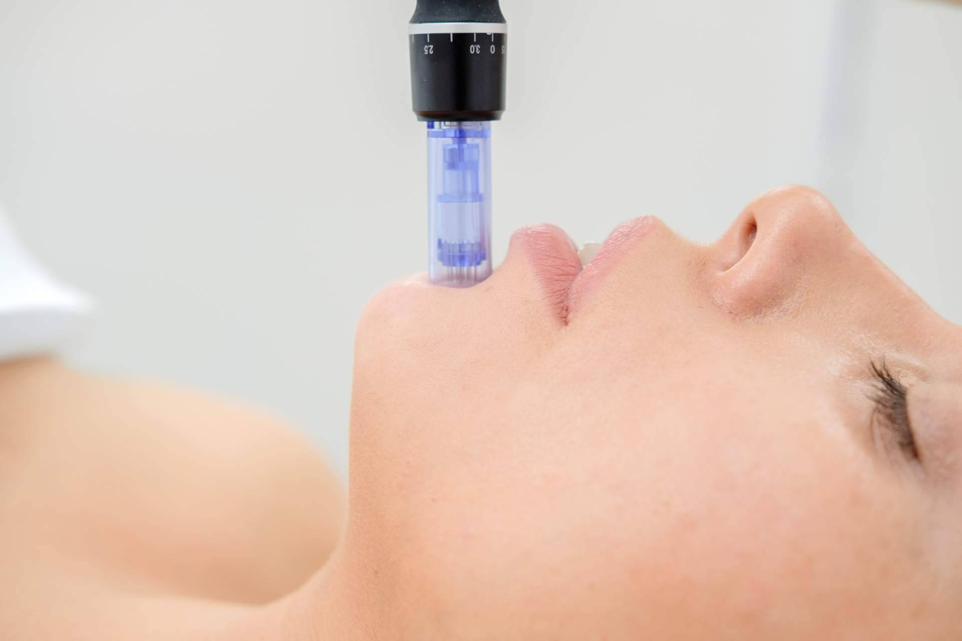 VG Virginia Gómez realiza el procedimiento de la mesoterapia facial