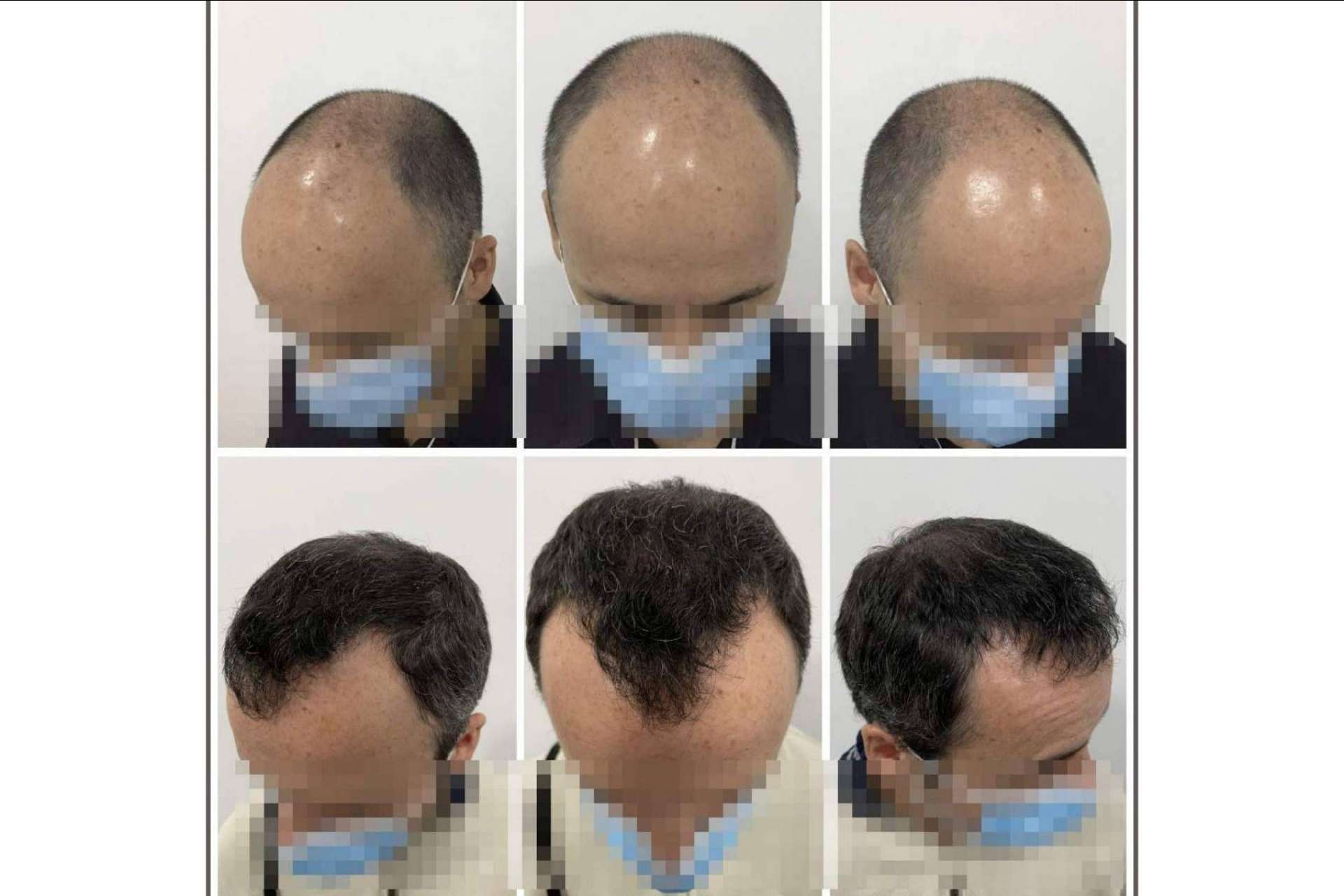 Dr. Bruno Jacobovski: ¿En qué consiste el tratamiento de mesoterapia capilar?