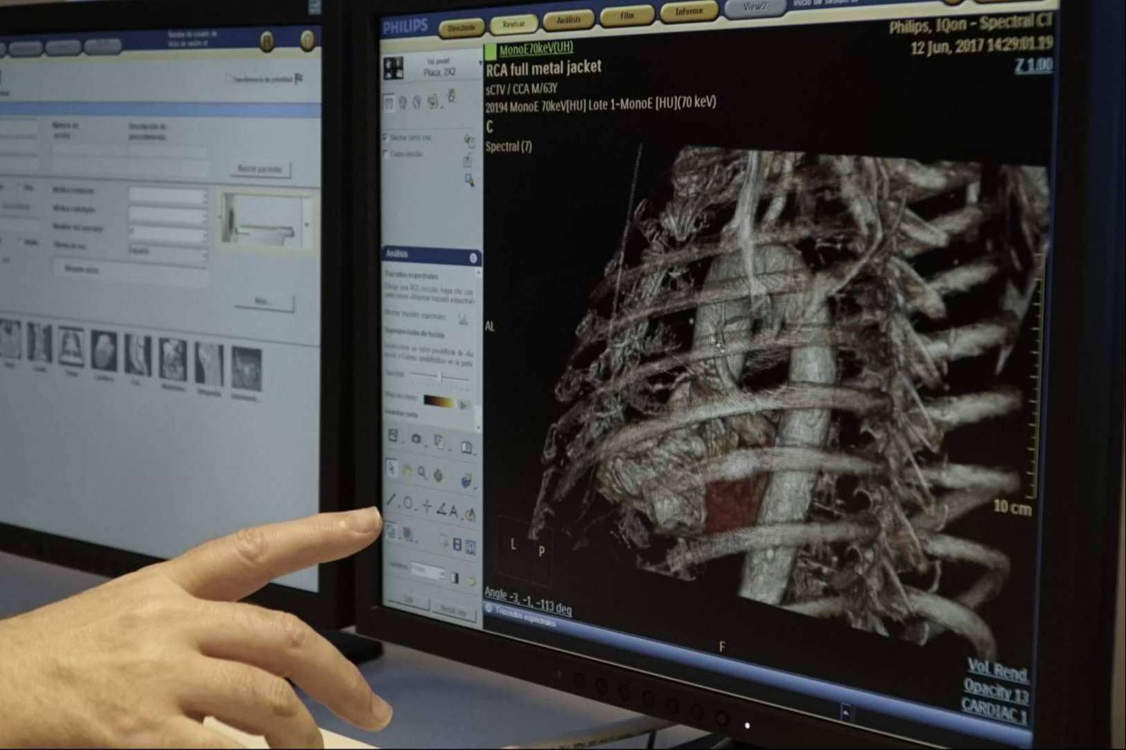 Prevenir y detectar patologías o anomalías cardiovasculares con el escáner de imagen espectral de Bach Care