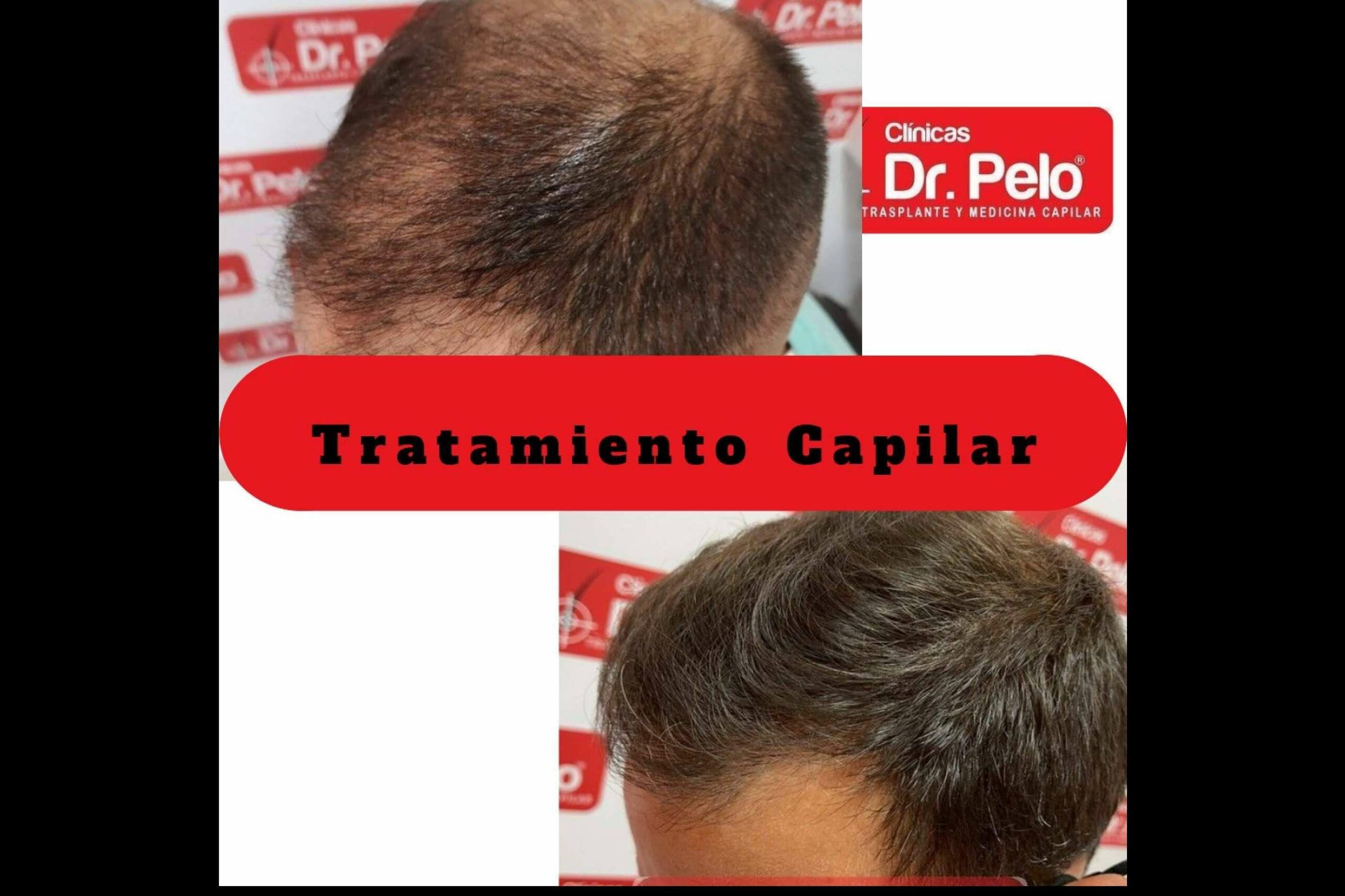 Tratamientos capilares de todo tipo en las Clínicas Dr. Pelo