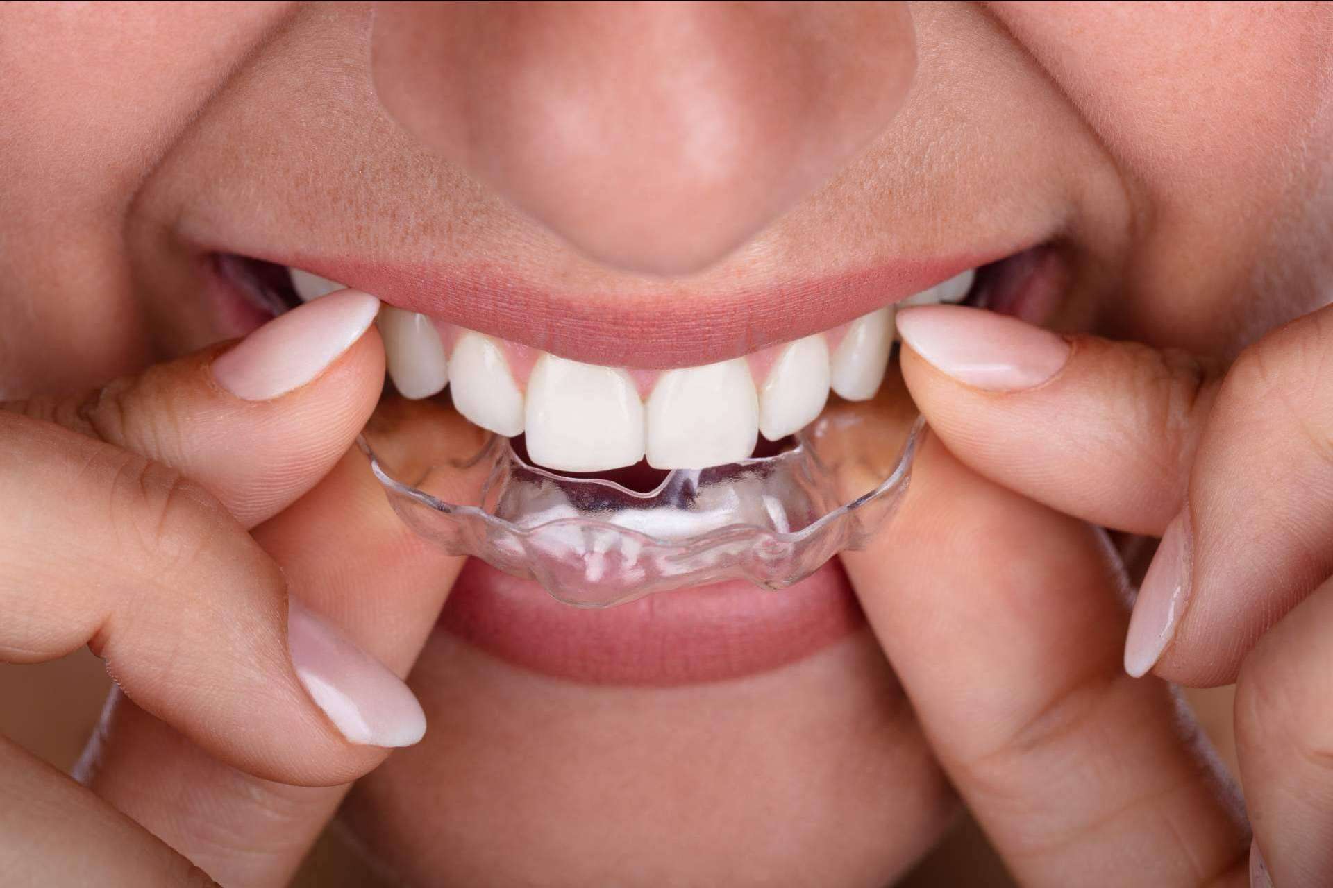 ¿Por qué elegir Smile Aligner como ortodoncia invisible?