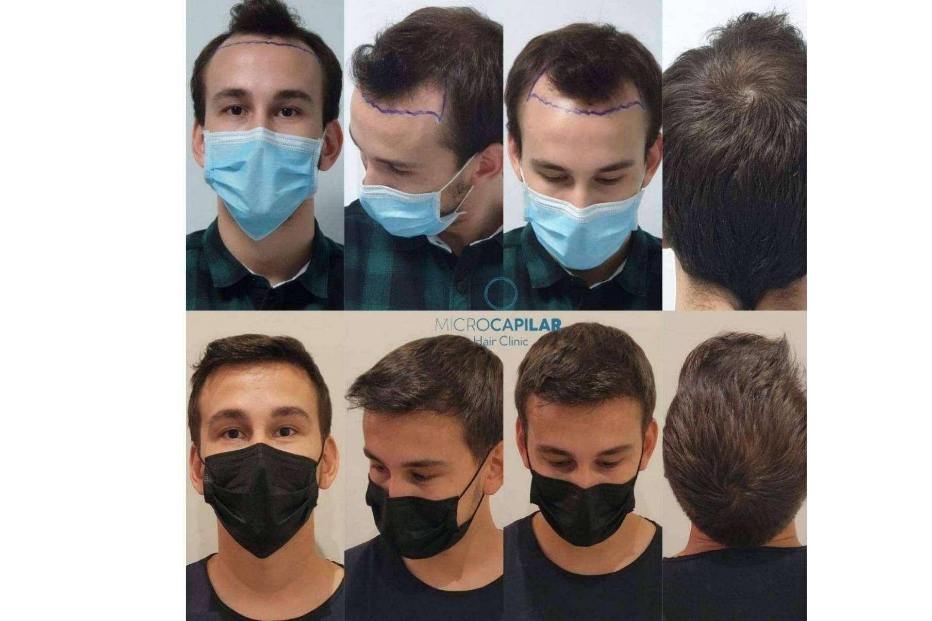 Las ventajas del servicio de Microcapilar Hair Clinic para realizar un injerto capilar en España