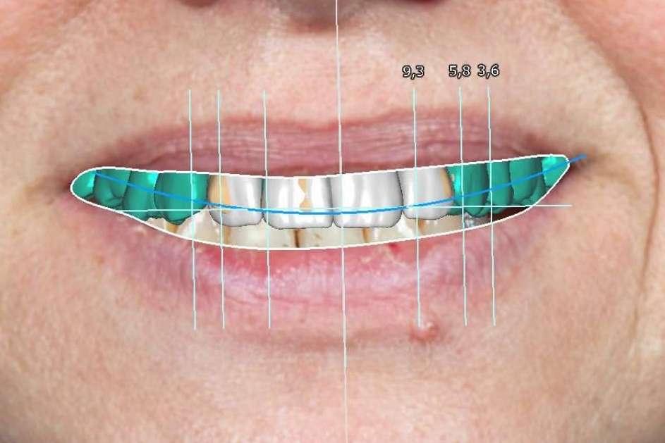 Clínica Blay+Monzó, equipo de especialistas en el diseño de sonrisas