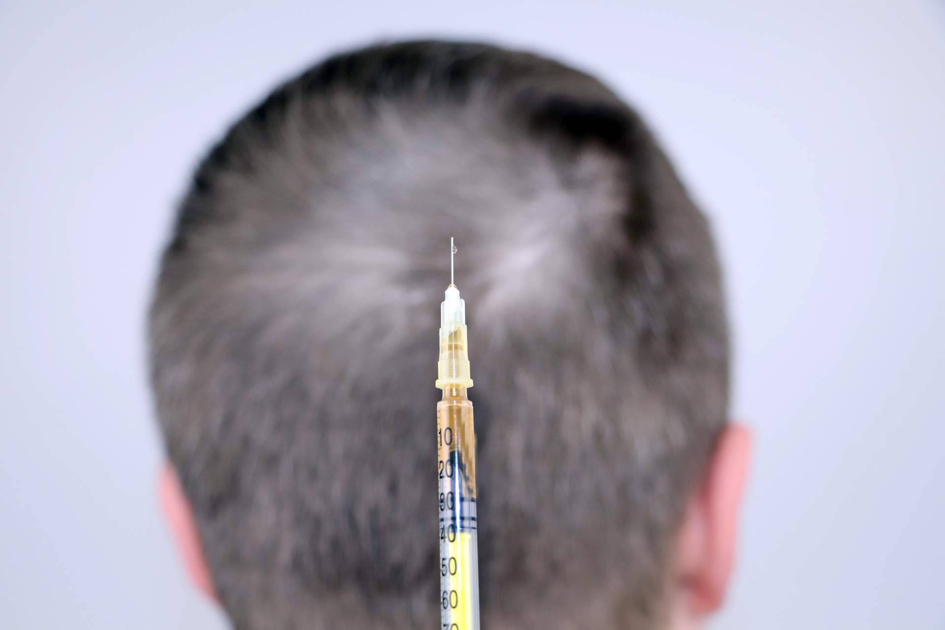 El tratamiento de mesoterapia capilar que realiza el Dr. Bruno Jacobovski se alza como una solución a la alopecia