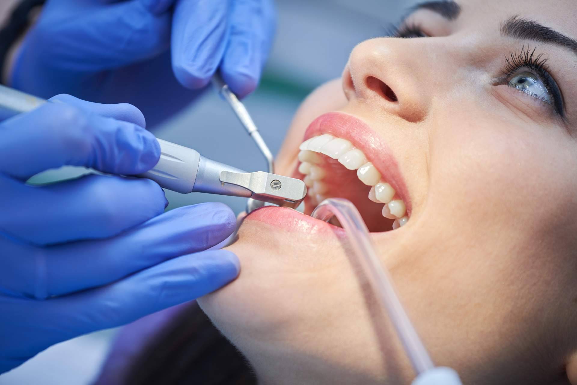 ¿Cómo se hacen limpiezas dentales profesionales?, por Helident Clínica Dental