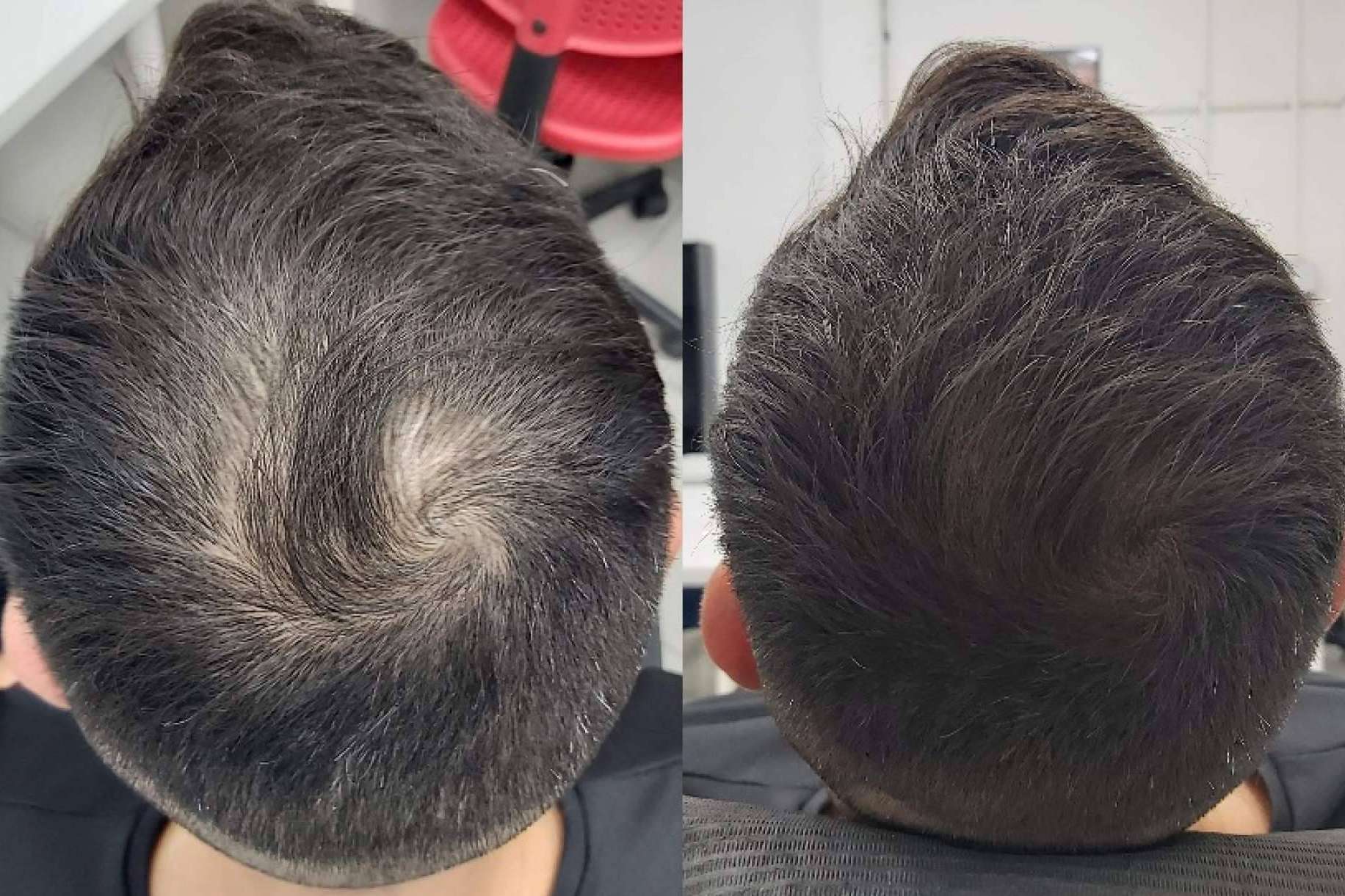 Los tratamientos de micropigmentación con efecto de redensificación disponibles en las Clínicas Dr. Pelo