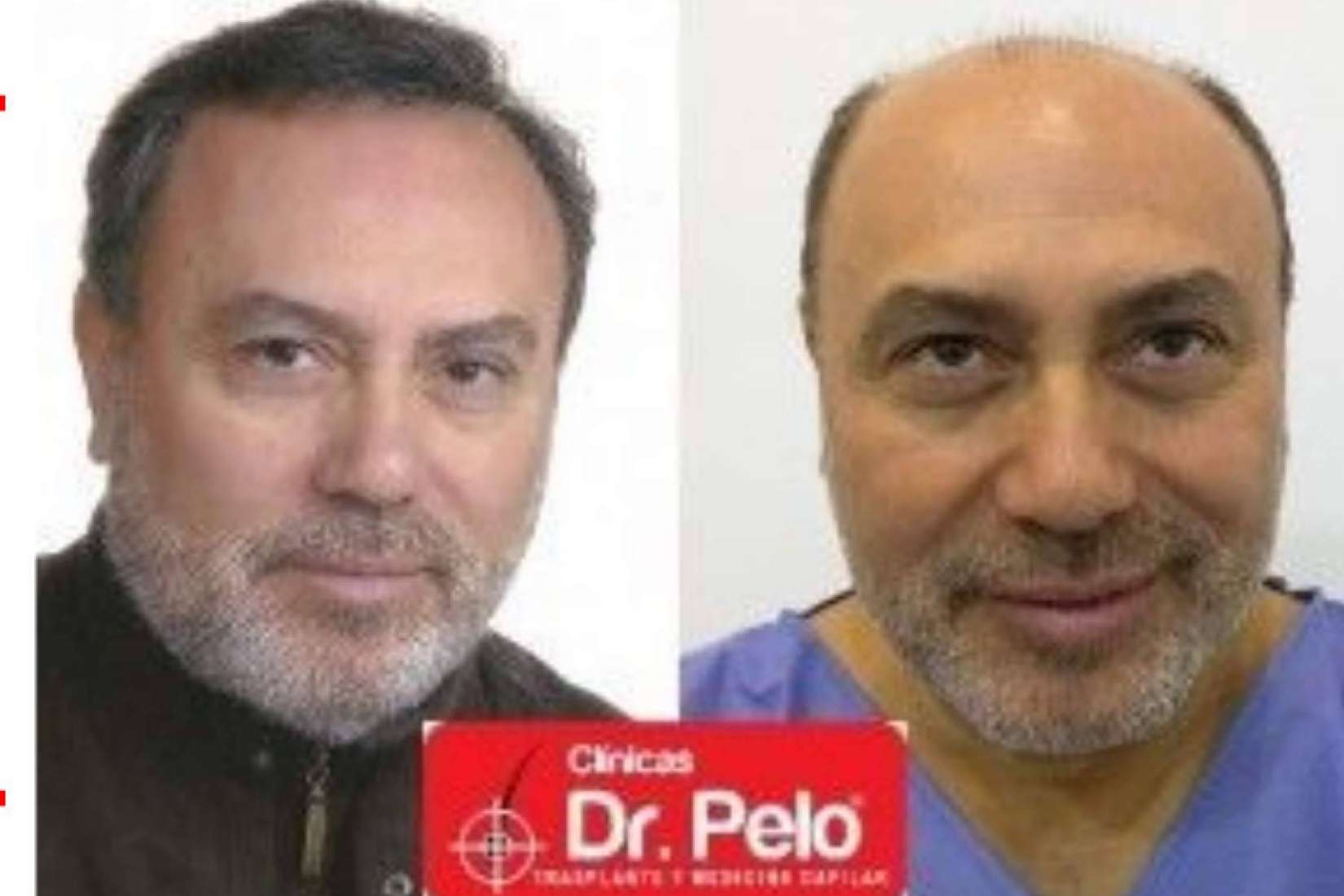 Trasplantes capilares con efecto natural realizados por Clínicas Dr. Pelo