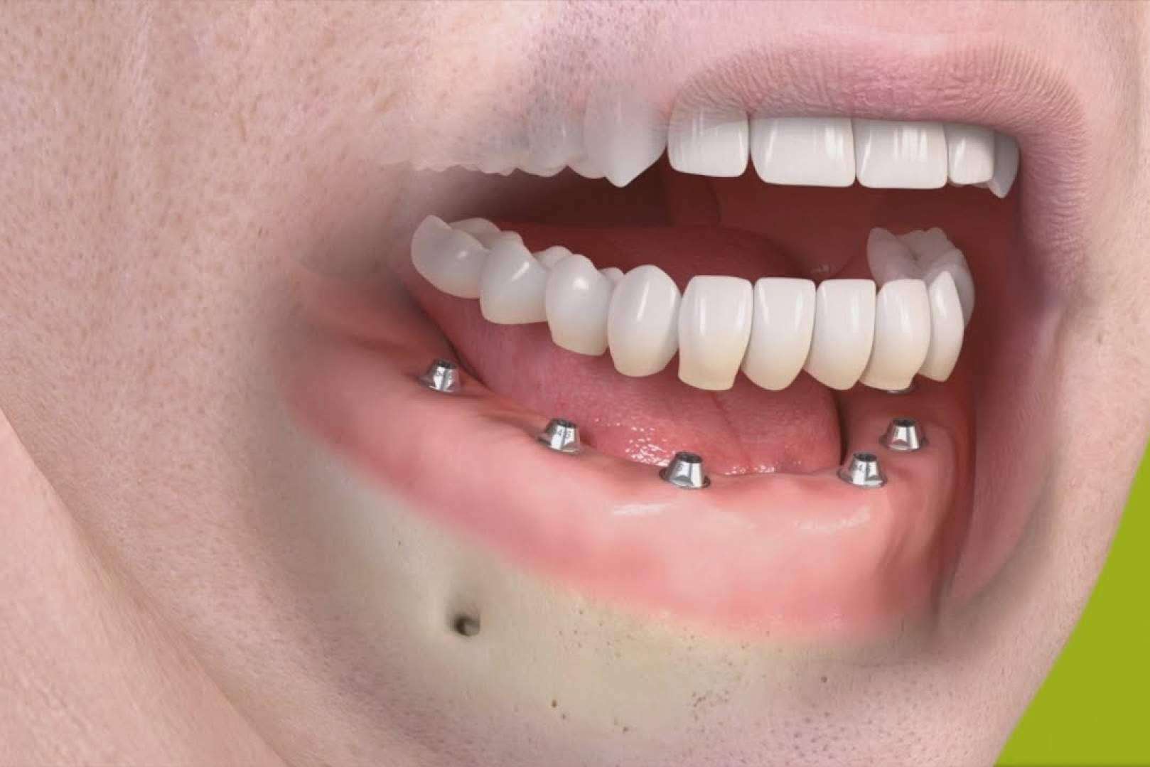 Rehabilitaciones orales complejas en un día en la clínica dental en Madrid Bordonclinic