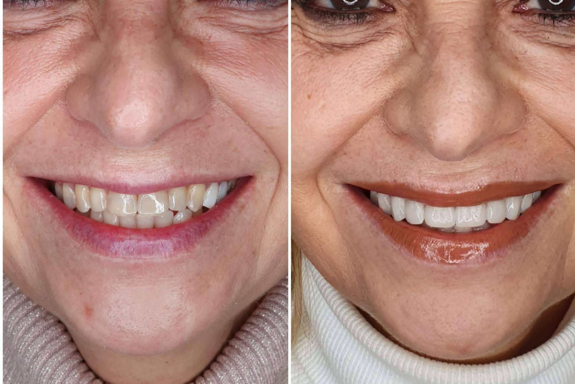 Dentinova permite lograr una estética dental adecuada en dos visitas