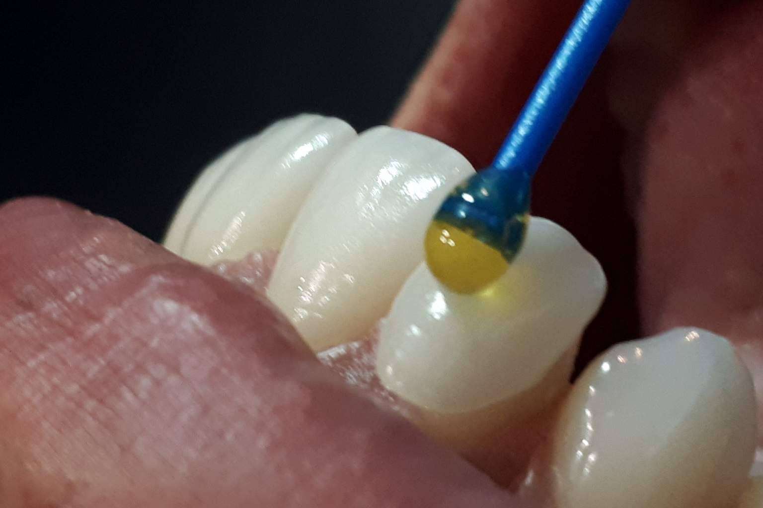Dentinova ofrece coronas dentarias impresas con tecnología 3D en una hora