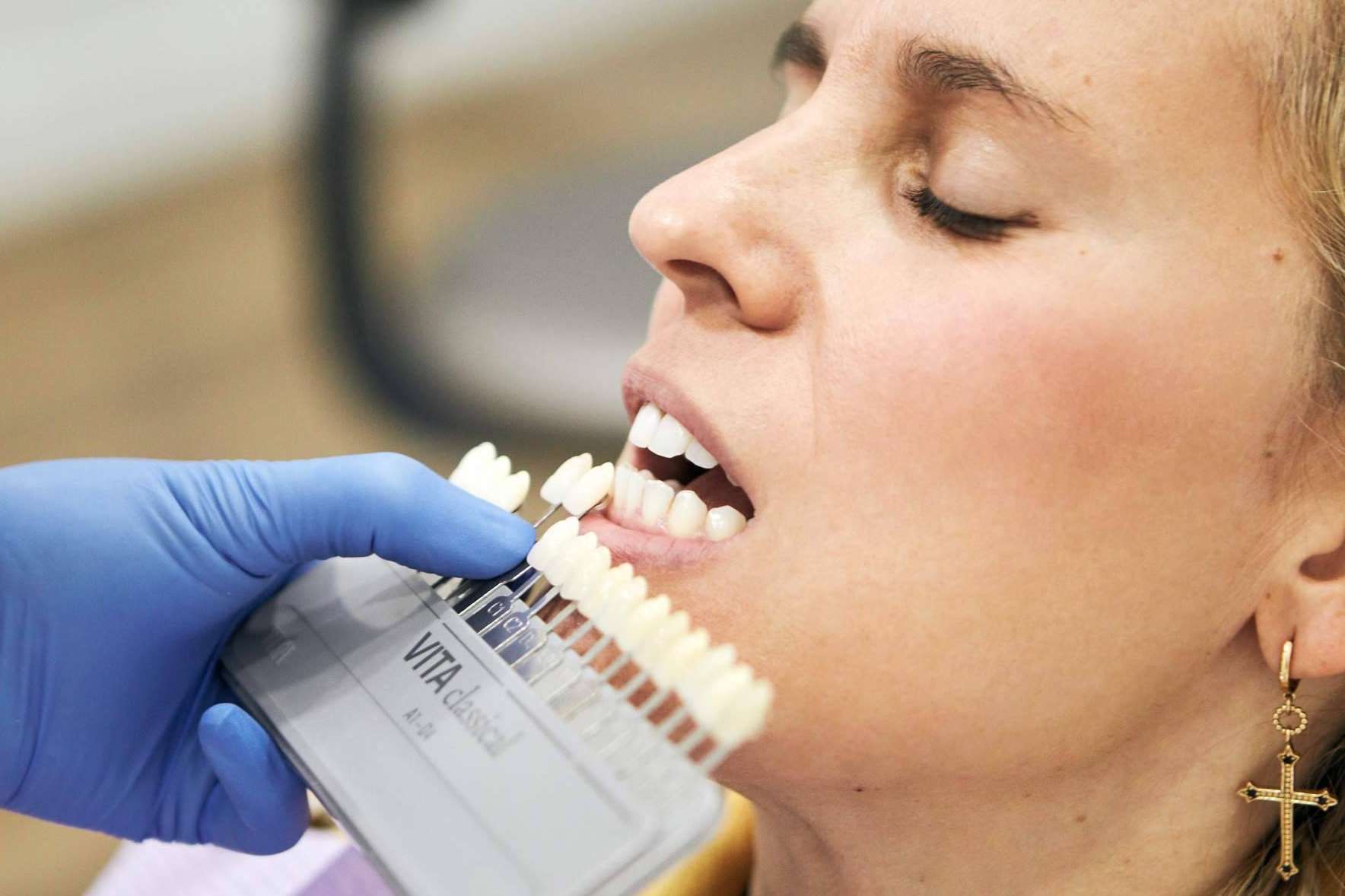Carillas dentales como solución a la rehabilitación estética