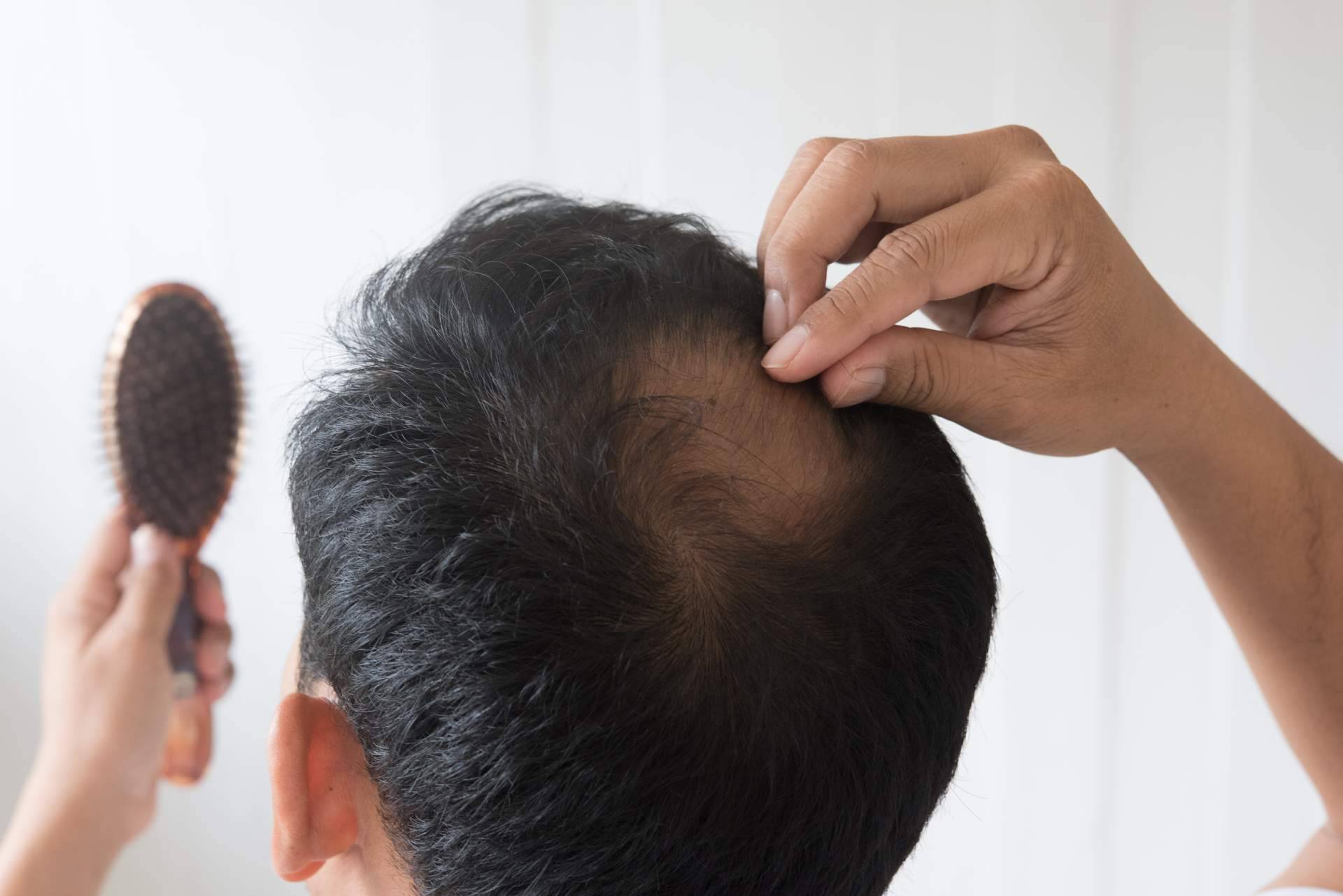 En Clínicas Be, realizan injertos capilares sin cicatrices