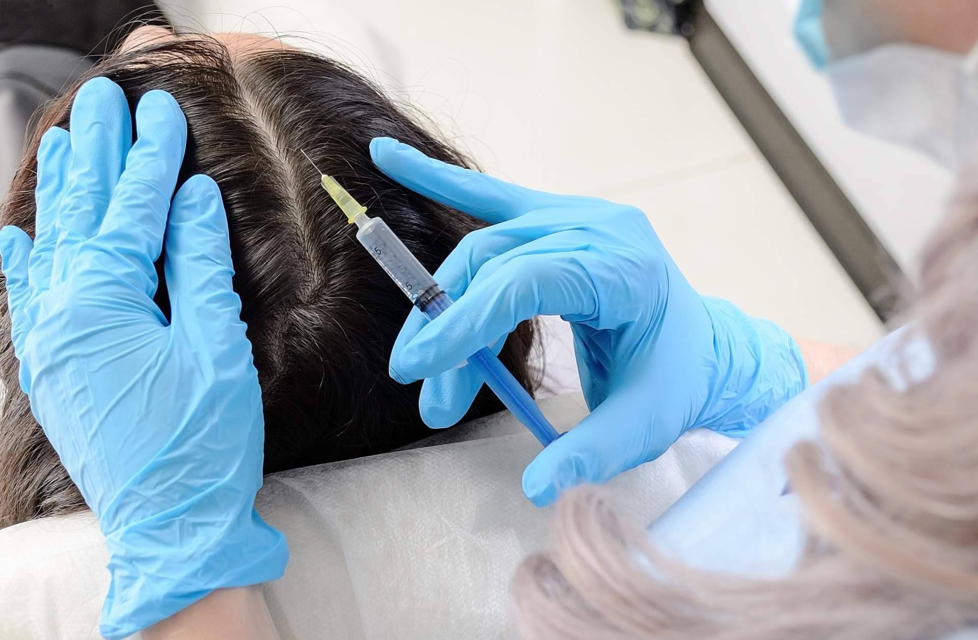 Plasma rico en plaquetas, mesoterapia capilar y vitaminas