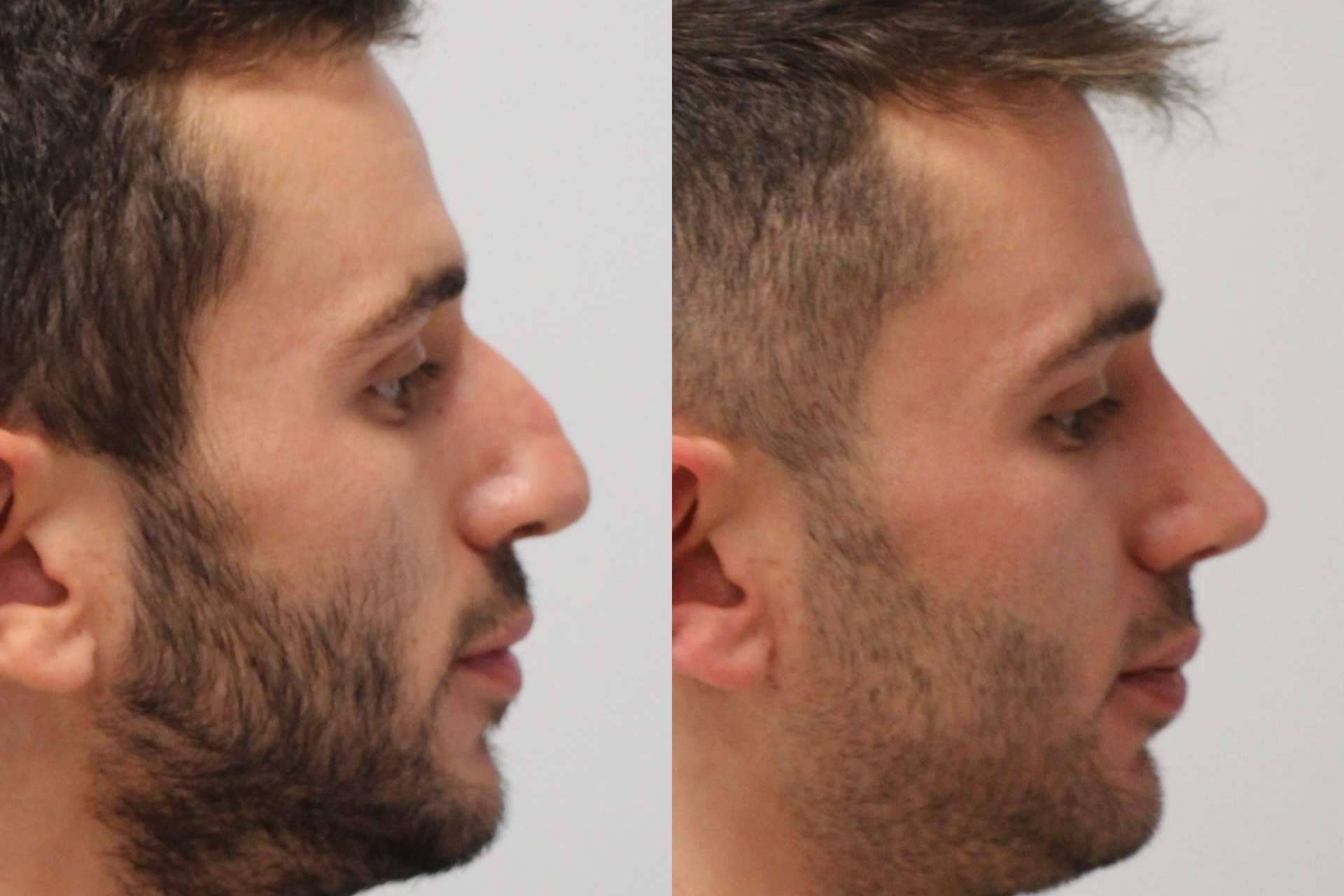 La rinoplastia ultrasónica, un avance médico que está disponible en Valladolid y Santander