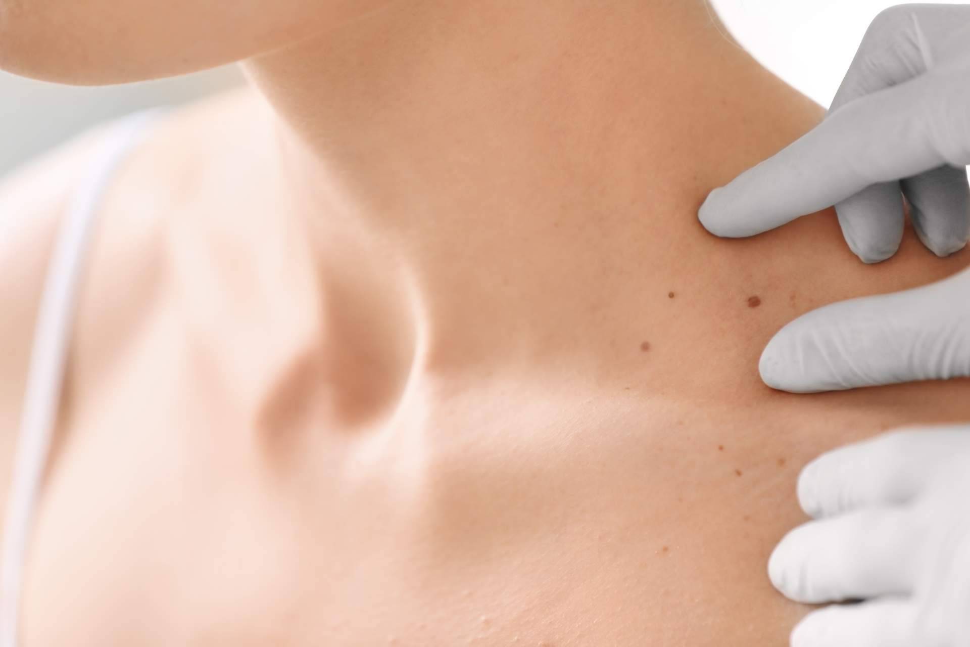 Tratar y prevenir las manchas en la piel en verano, por Farmacia Laura Garín