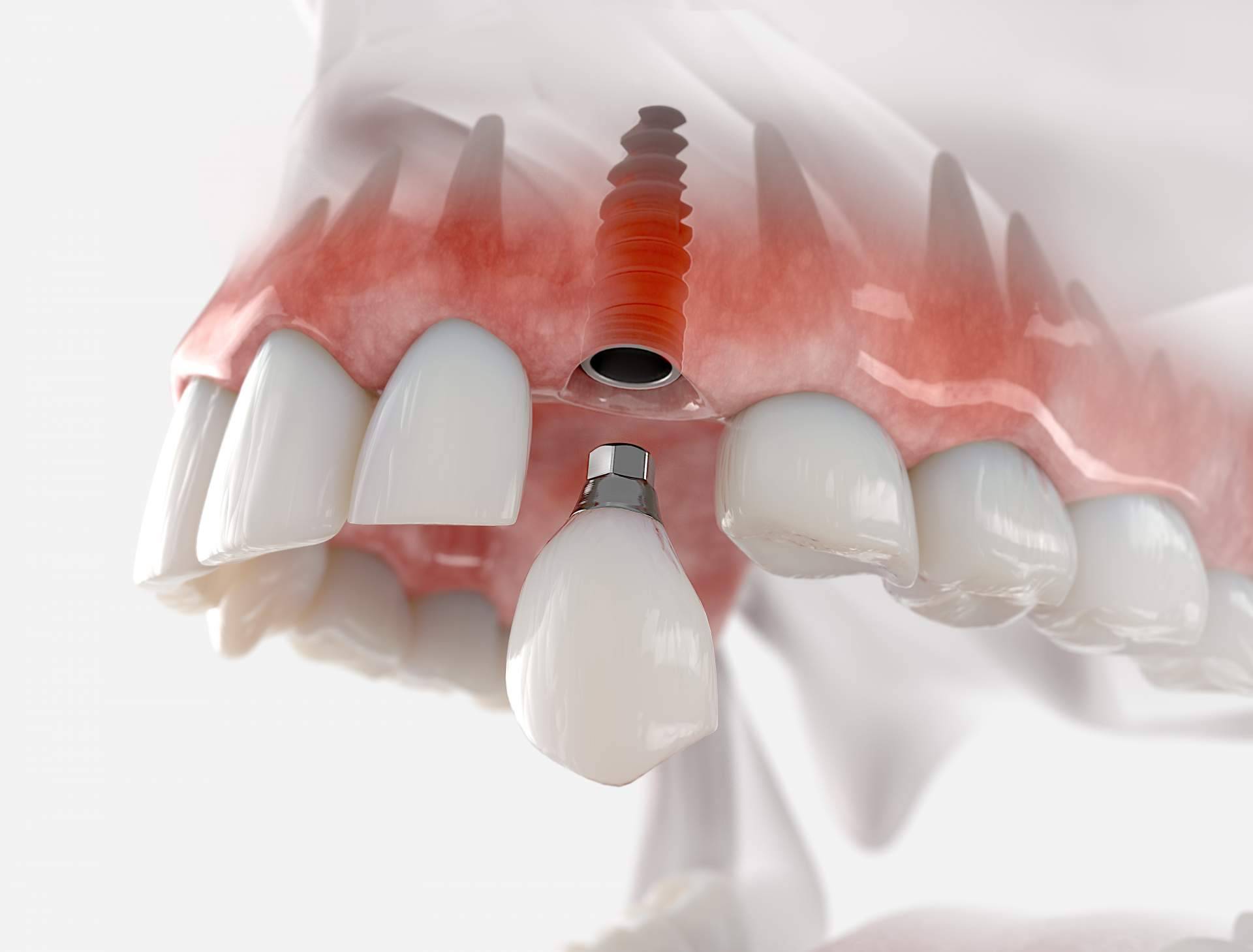 Implantes postextracción con carga inmediata, la técnica de Clínica Dental Sonrisas para lograr una dentadura excelente en sus pacientes