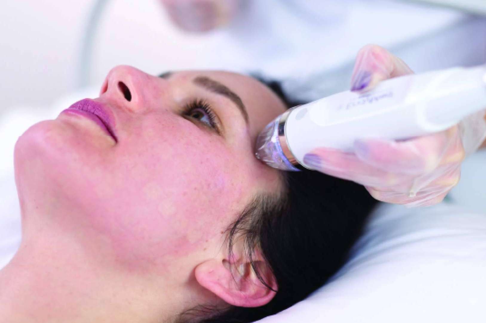 El tratamiento de radiofrecuencia fragmentada con microagujas de Alluring Clinic