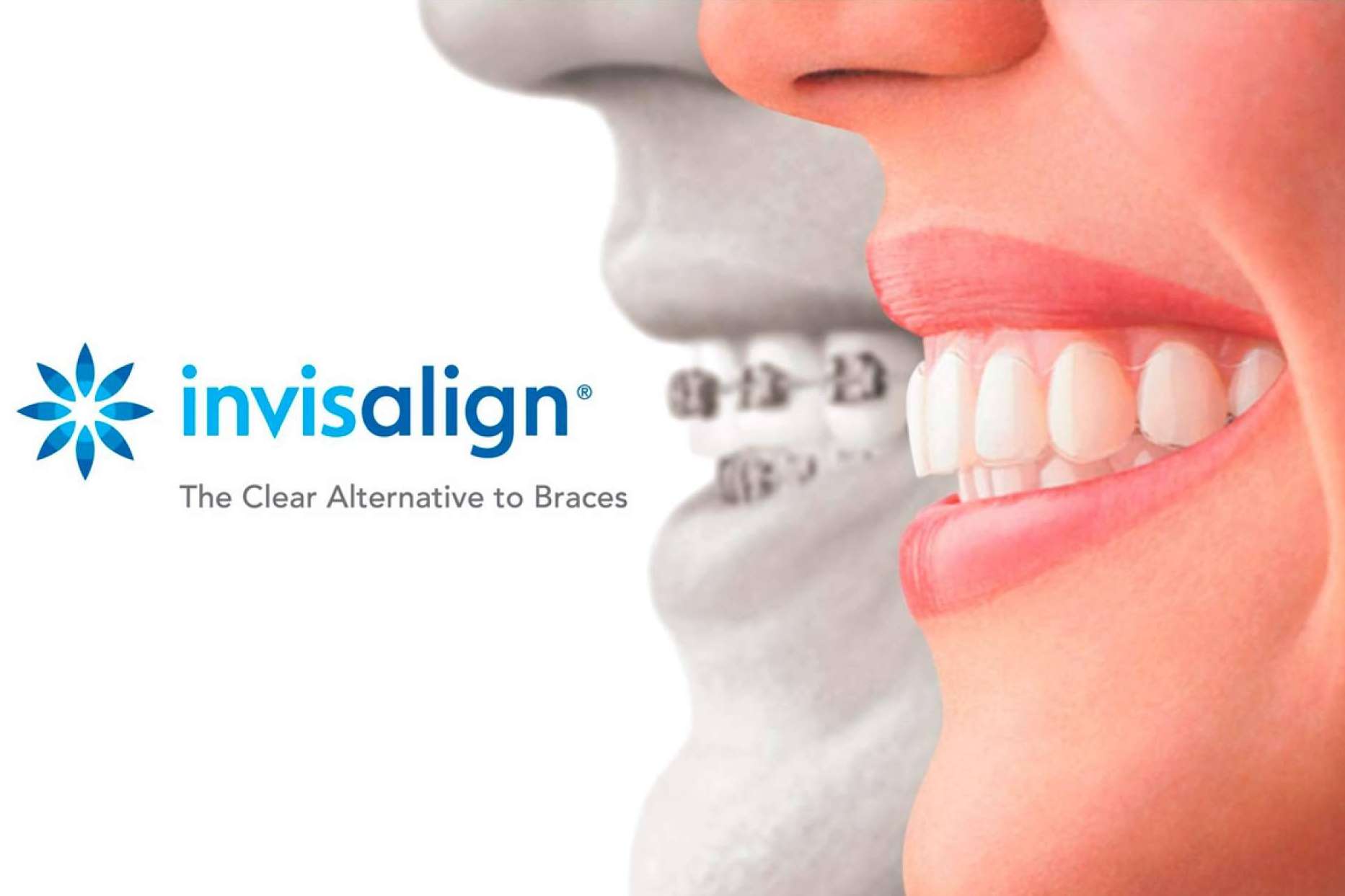 Estética y comodidad con la ortodoncia invisible Invisalign