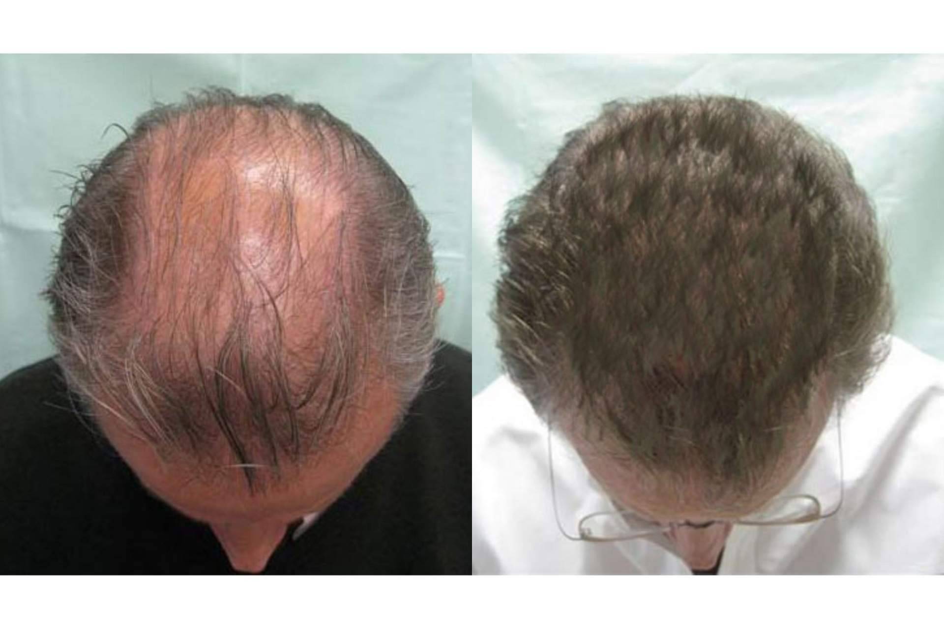 Tratamientos efectivos para alopecia androgenética en Innovación Capilar