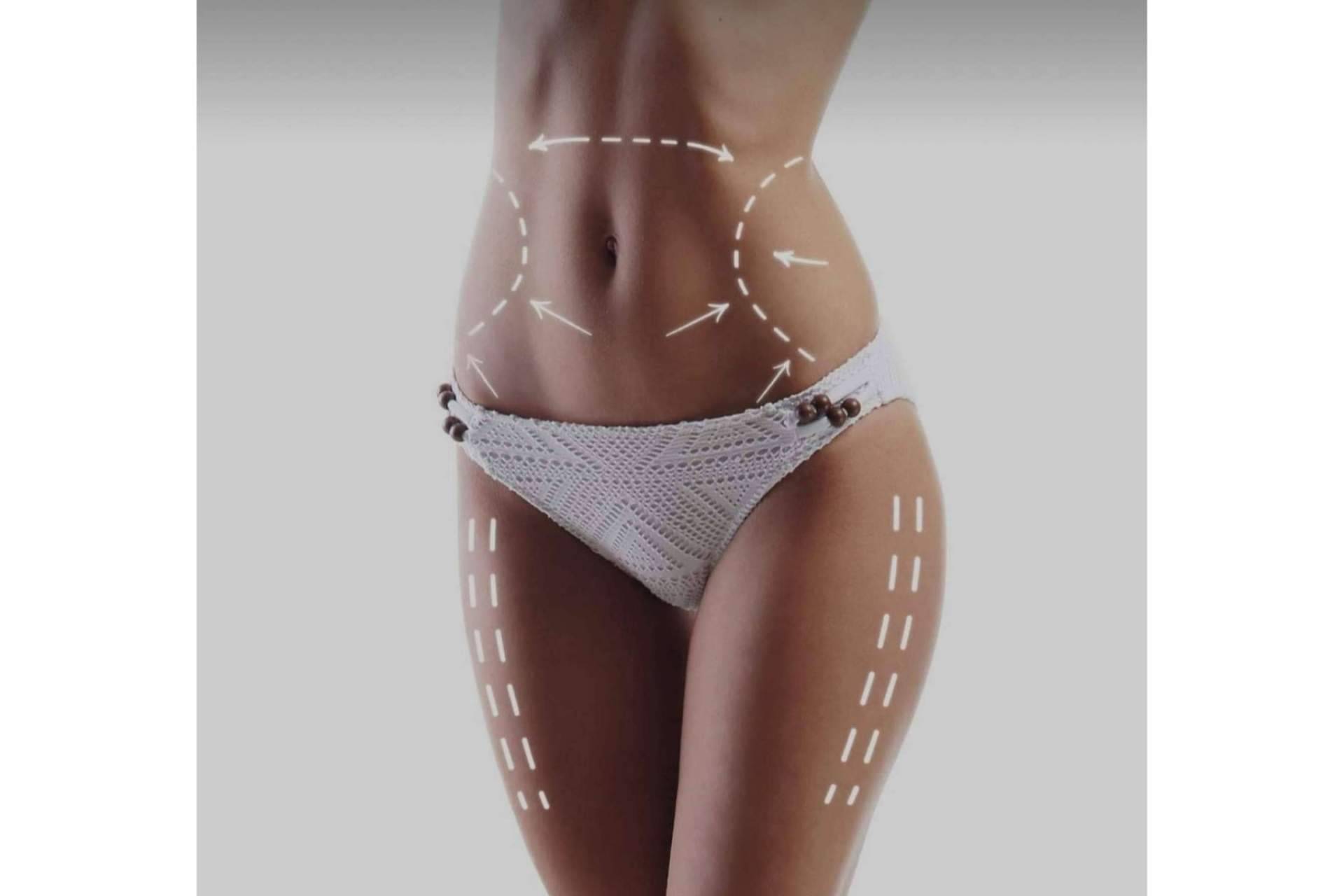 Mesoterapia corporal, tratamiento de grasa localizada y celulitis en la clínica de la Dra. Sánchez-Peral