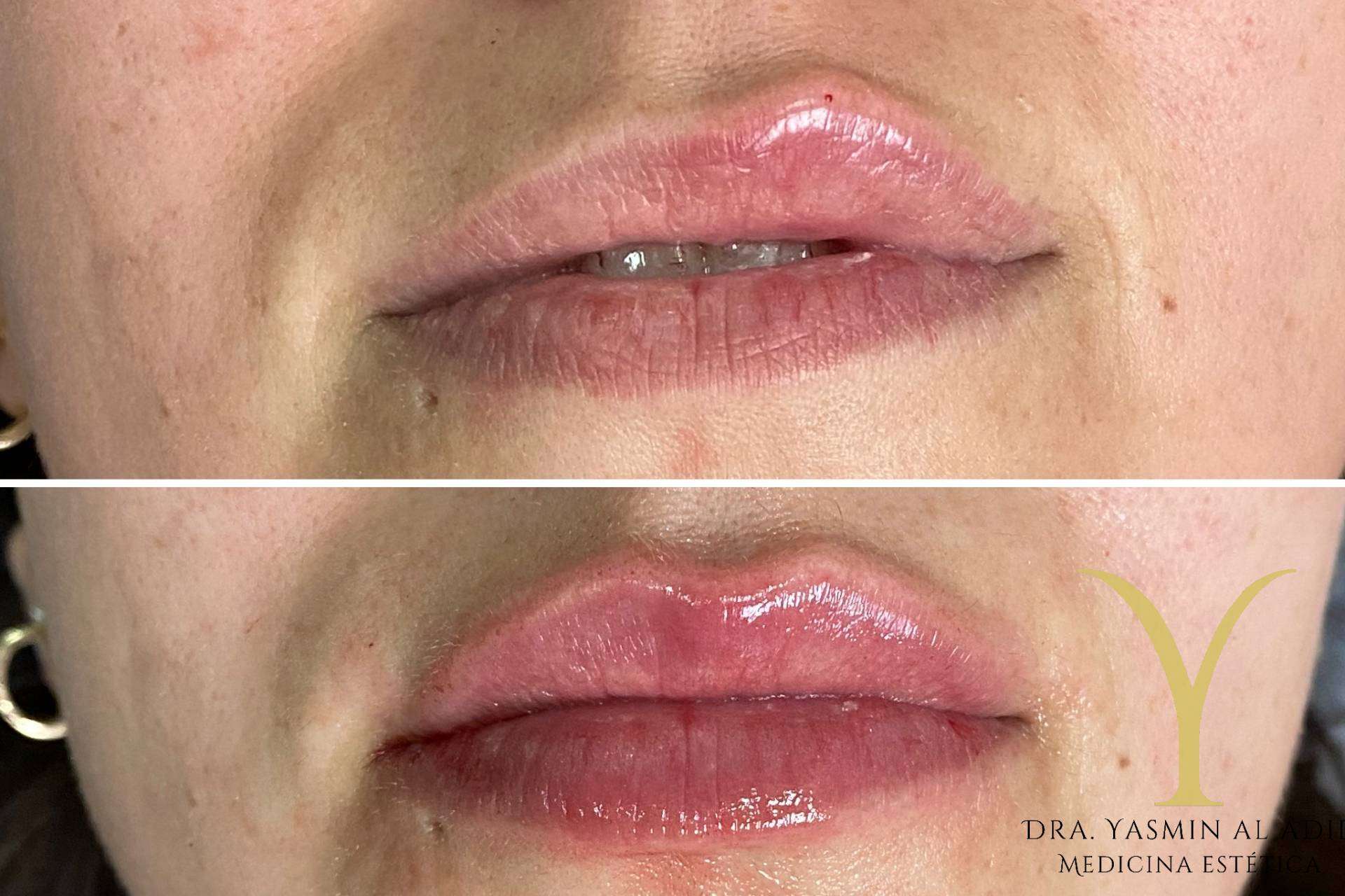 La técnica, Adiblips, de la Clínica Yasmin para el aumento de labios con ácido hialurónico