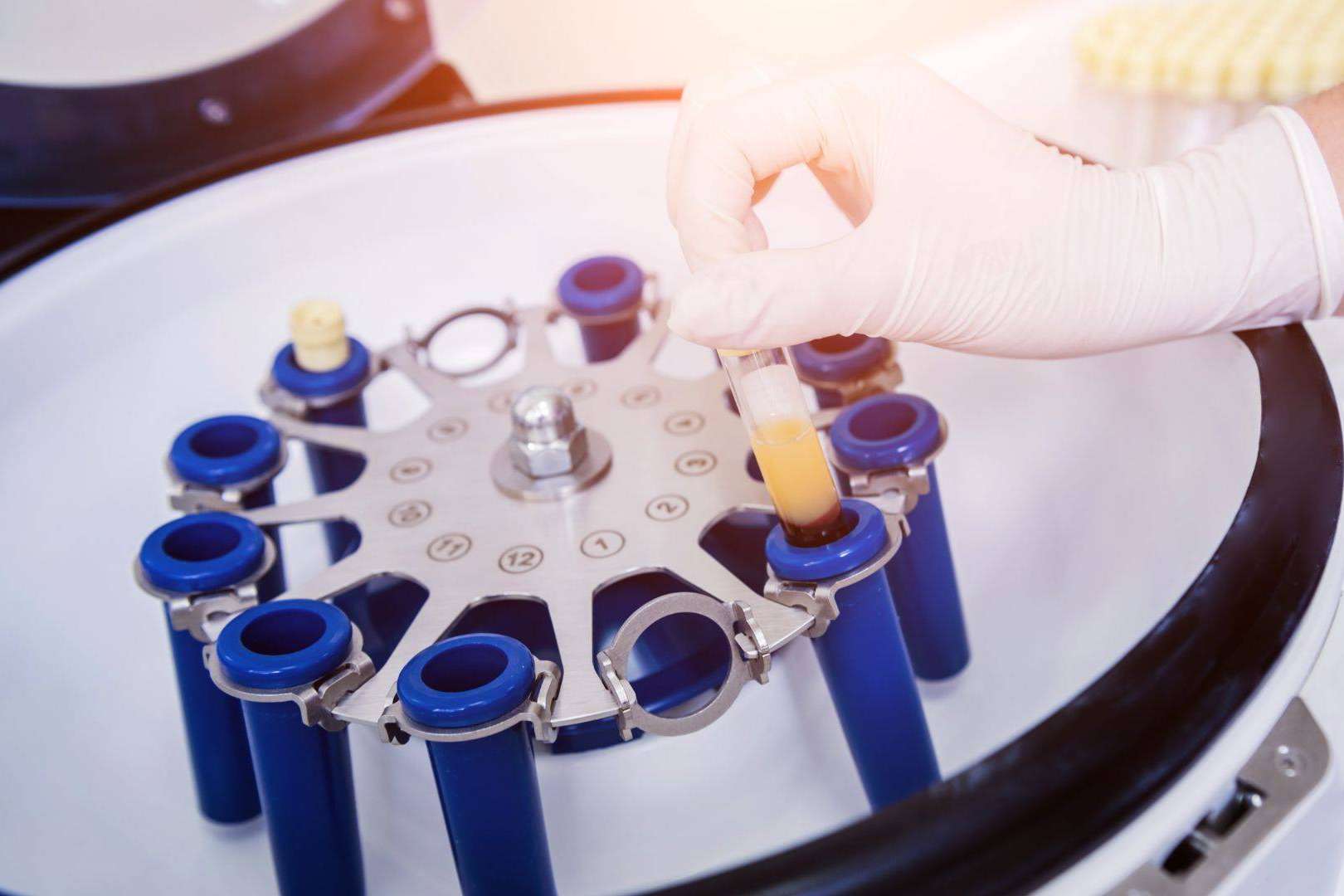 Plasma rico en plaquetas y dutasterida, la potente terapia regenerativa de doble efecto contra la caída del cabello