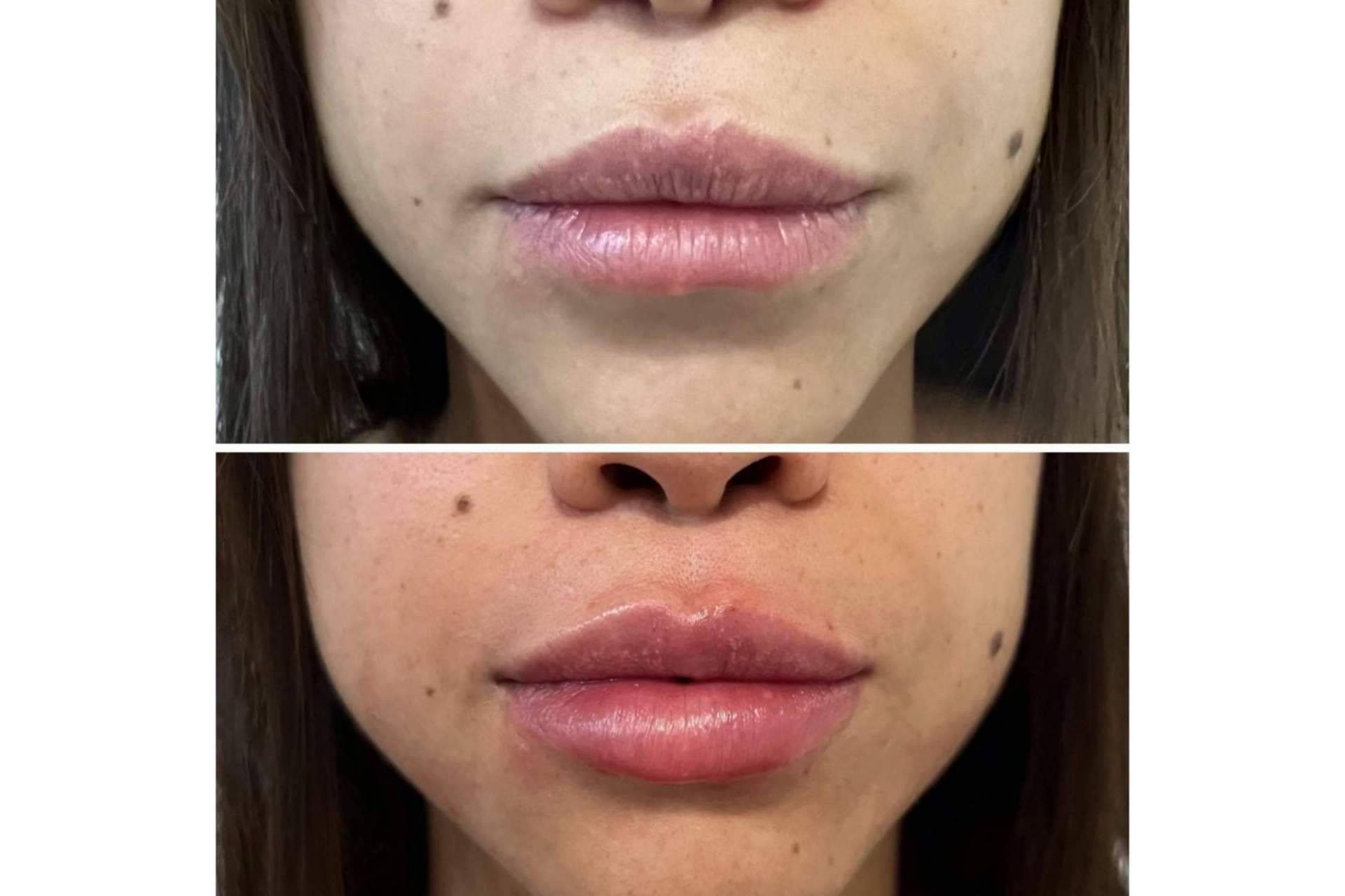¿Es posible realizarse un aumento de labios en Madrid con resultados naturales?, por la Dra. Cecilia Arthur