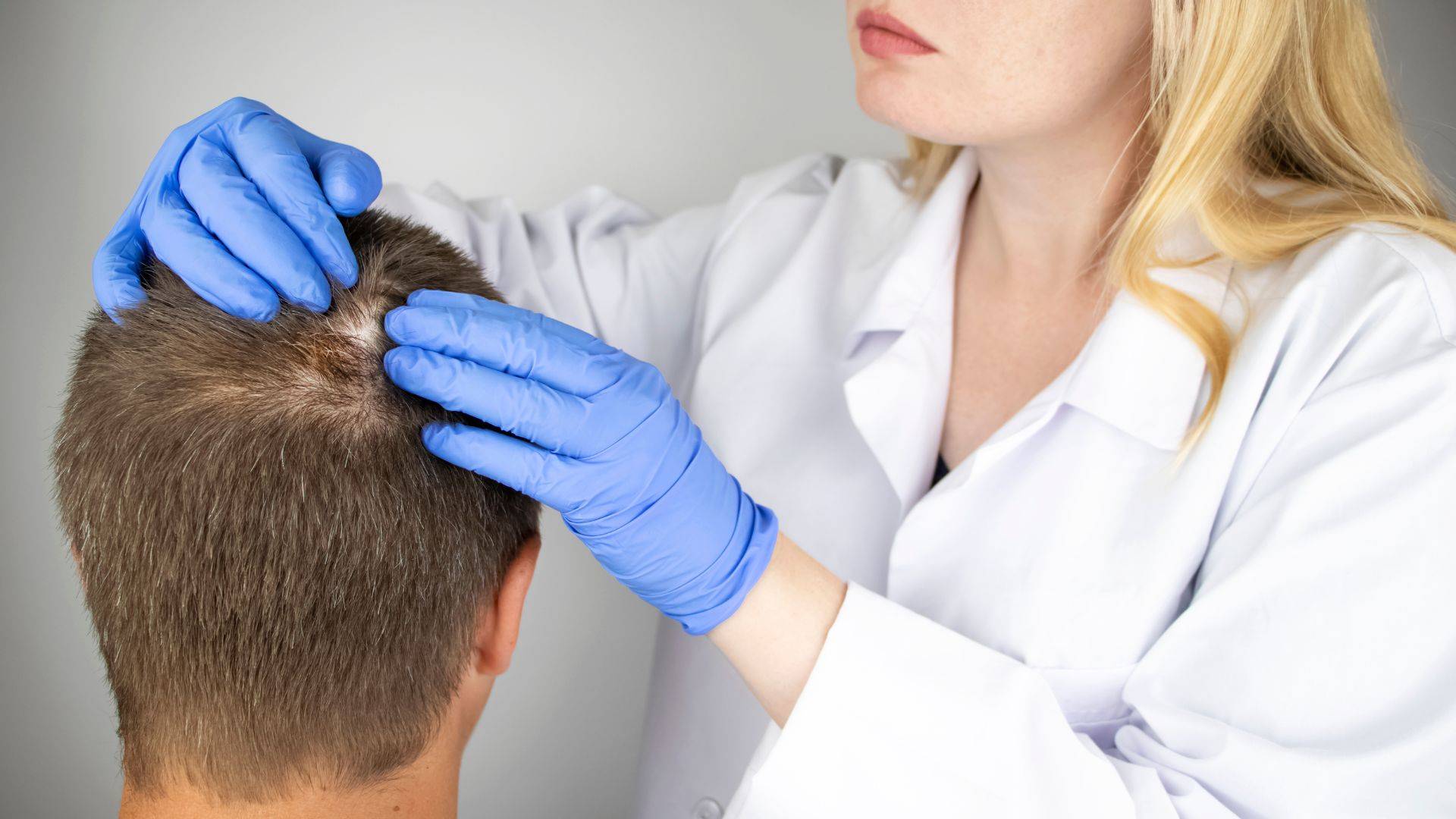 Alopecia por tiña del cuero cabelludo, ¿pueden contagiar los perros?