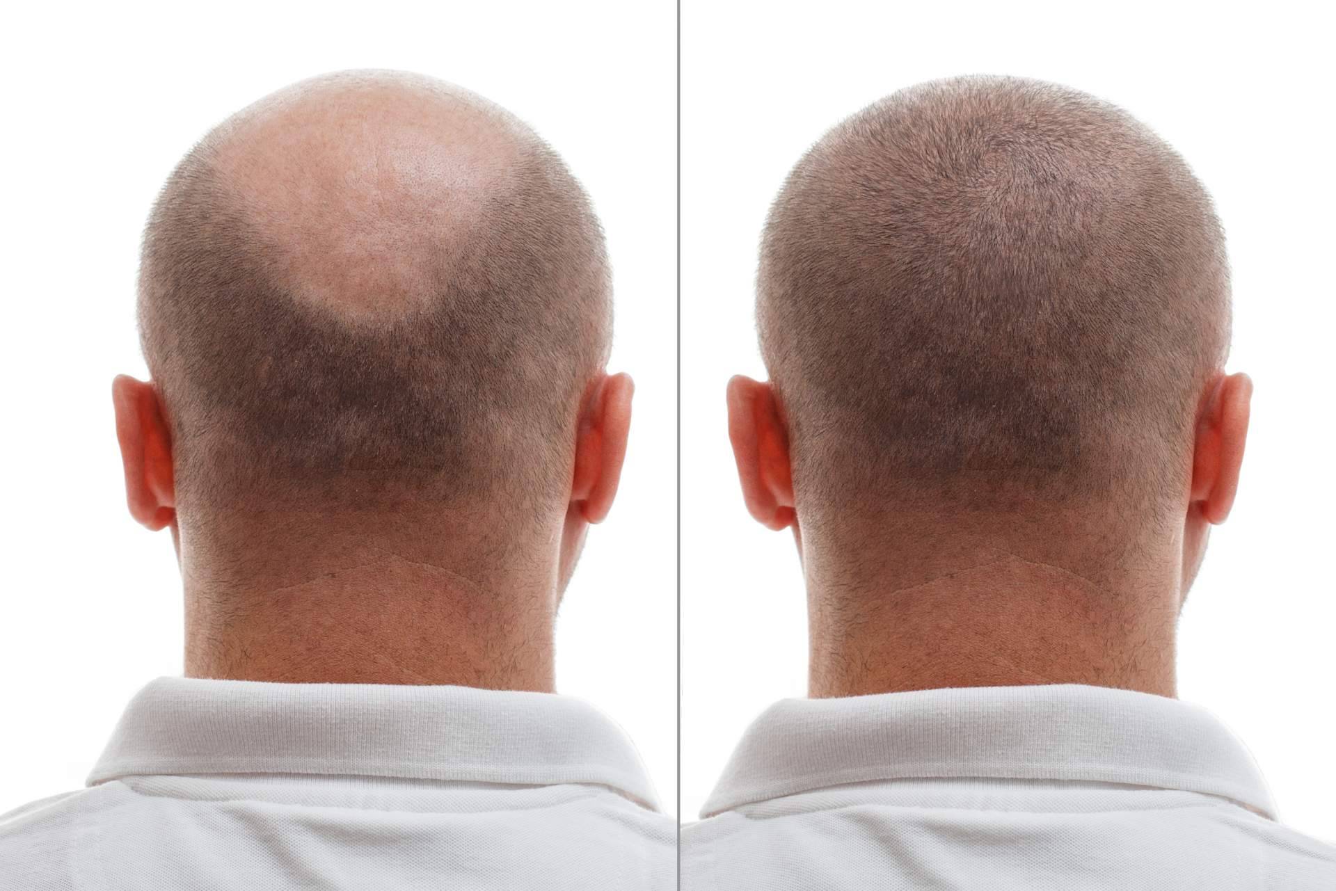 El trasplante de pelo en la coronilla se convierte en la solución definitiva para la alopecia en esta zona
