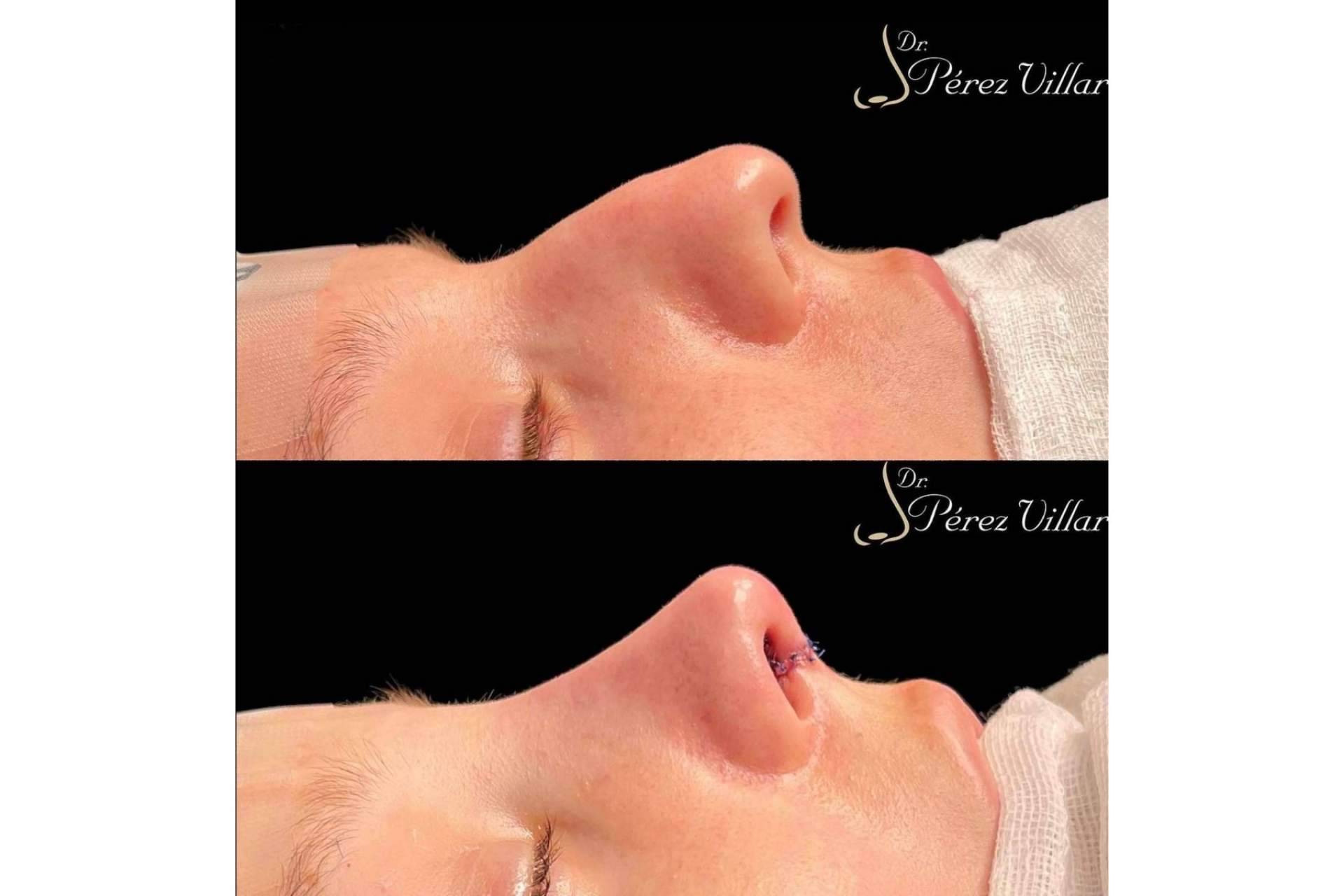 La rinoplastia ultrasónica de preservación es una técnica cada vez más presente en el mundo de la estética, por el Dr. Álvaro Pérez-Villar Bonet