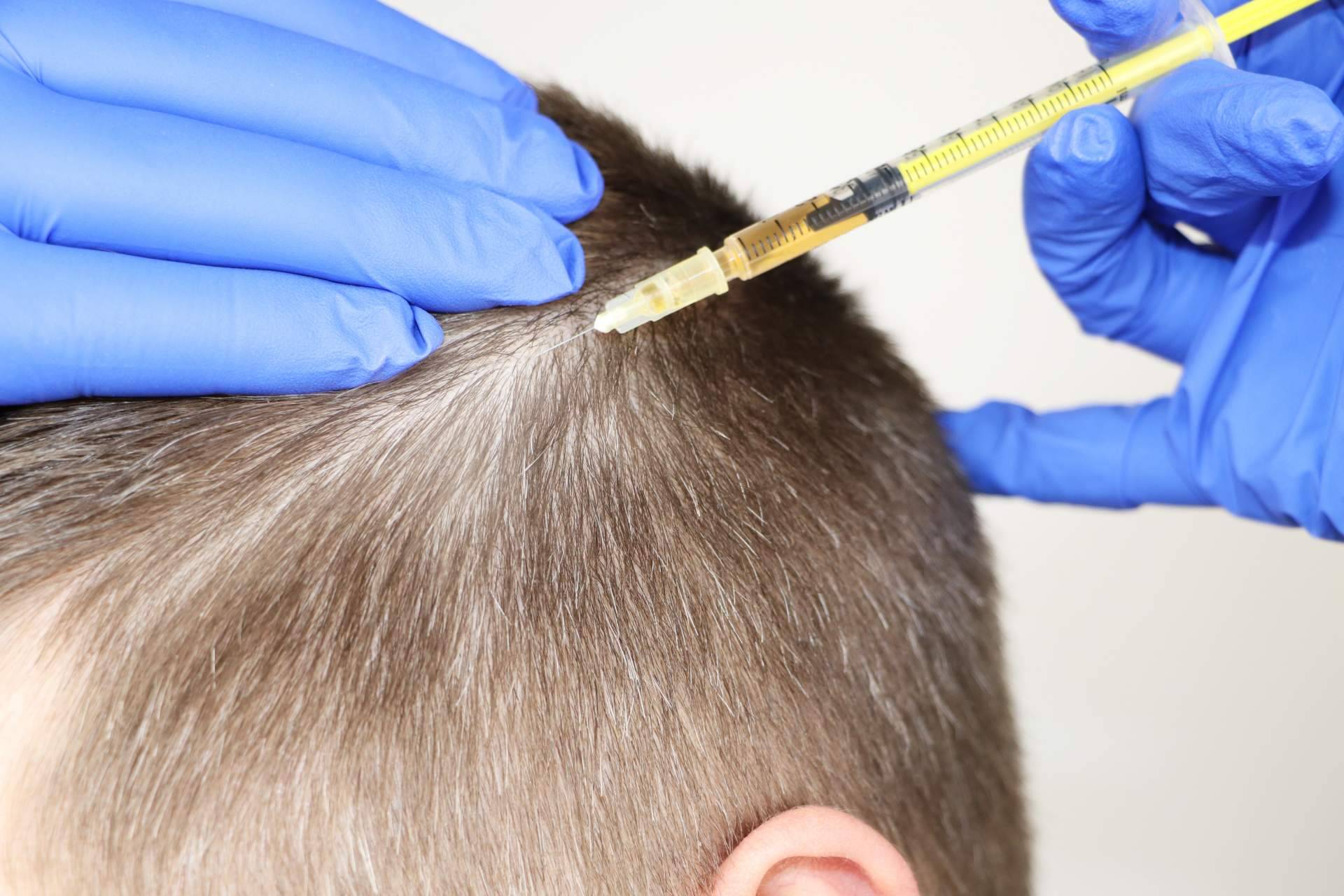 Crina Rus Beauty Center sobre los beneficios de la mesoterapia capilar Madrid